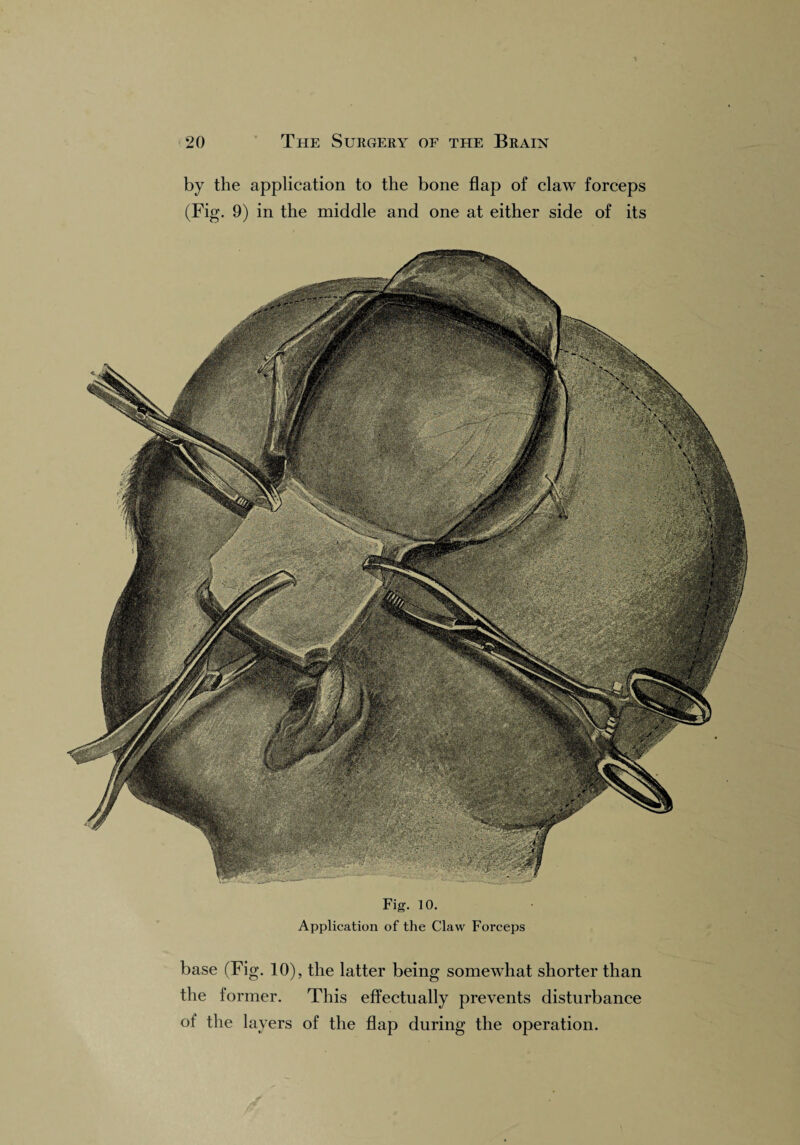 by the application to the bone flap of claw forceps (Fig. 9) in the middle and one at either side of its Fig. 10. Application of the Claw Forceps base (Fig. 10), the latter being somewhat shorter than the former. This effectually prevents disturbance of the layers of the flap during the operation.