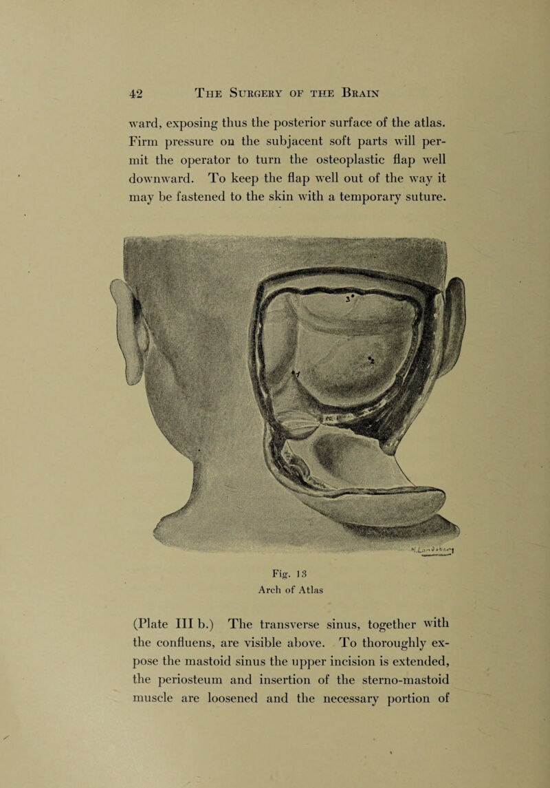 ward, exposing thus the posterior surface of the atlas. Firm pressure on the subjacent soft parts will per¬ mit the operator to turn the osteoplastic flap well downward. To keep the flap well out of the way it may be fastened to the skin with a temporary suture. Fig. 13 Arch of Atlas (Plate III b.) The transverse sinus, together with the confluens, are visible above. To thoroughly ex¬ pose the mastoid sinus the upper incision is extended, the periosteum and insertion of the sterno-mastoid muscle are loosened and the necessary portion of