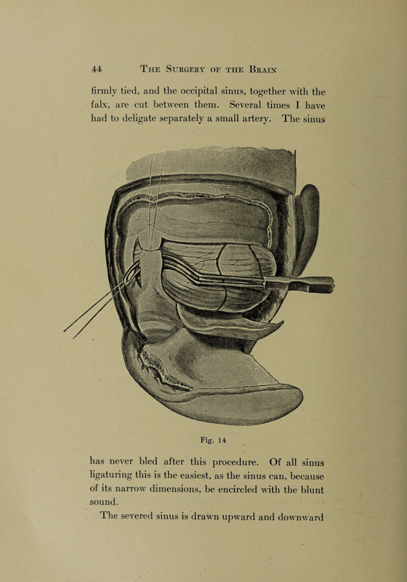firmly tied, and the occipital sinus, together with the falx, are cut between them. Several times I have had to deligate separately a small artery. The sinus Fig. 14 has never bled after this procedure. Of all sinus ligaturing this is the easiest, as the sinus can, because of its narrow dimensions, be encircled with the blunt sound. The severed sinus is drawn upward and downward