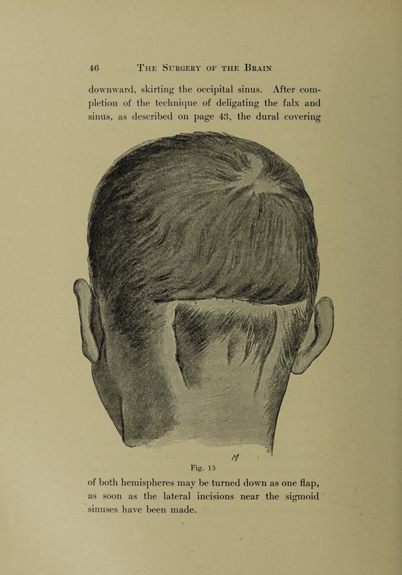 downward, skirting the occipital sinus. After com¬ pletion of the technique of deligating the falx and sinus, as described on page 43, the dural covering Fig. 15 of both hemispheres may be turned down as one flap, as soon as the lateral incisions near the sigmoid sinuses have been made.