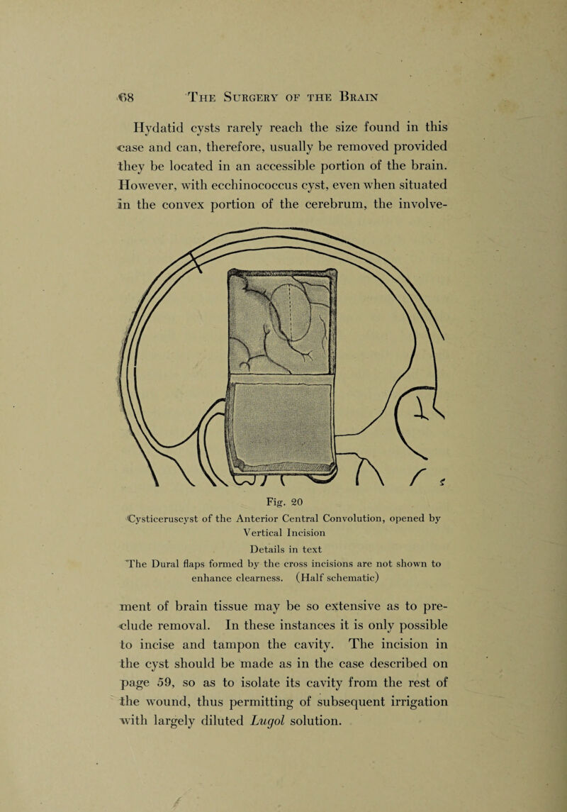 Hydatid cysts rarely reach the size found in this case and can, therefore, usually be removed provided they be located in an accessible portion of the brain. However, with ecchinococcus cyst, even when situated in the convex portion of the cerebrum, the involve- Fig. 20 Cysticeruscyst of the Anterior Central Convolution, opened by Vertical Incision Details in text The Dural flaps formed by the cross incisions are not shown to enhance clearness. (Half schematic) ment of brain tissue may be so extensive as to pre¬ clude removal. In these instances it is only possible to incise and tampon the cavity. The incision in the cyst should be made as in the case described on page 59, so as to isolate its cavity from the rest of the wound, thus permitting of subsequent irrigation with largely diluted Lugol solution.