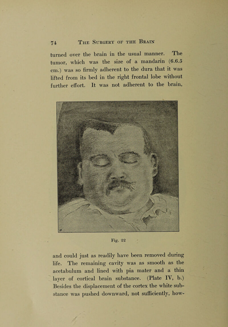 turned over the brain in the usual manner. The tumor, which was the size of a mandarin (6.6.5 cm.) was so firmly adherent to the dura that it was lifted from its bed in the right frontal lobe without further effort. It was not adherent to the brain, Fig. 22 and could just as readily have been removed during life. The remaining cavity was as smooth as the acetabulum and lined with pia mater and a thin layer of cortical brain substance. (Plate IV, b.) Besides the displacement of the cortex the white sub¬ stance was pushed downward, not sufficiently, how-