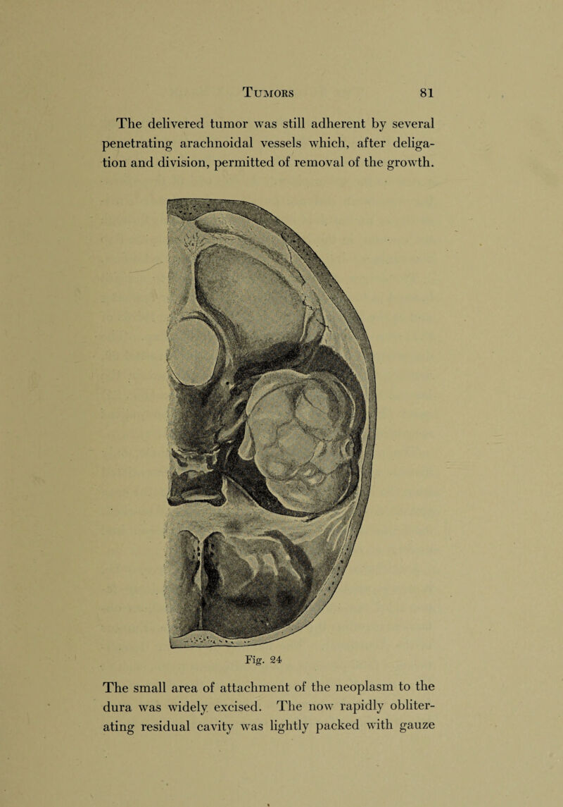 The delivered tumor was still adherent by several penetrating arachnoidal vessels which, after deliga¬ tion and division, permitted of removal of the growth. Fig. 24 The small area of attachment of the neoplasm to the dura was widely excised. The now rapidly obliter¬ ating residual cavity was lightly packed with gauze
