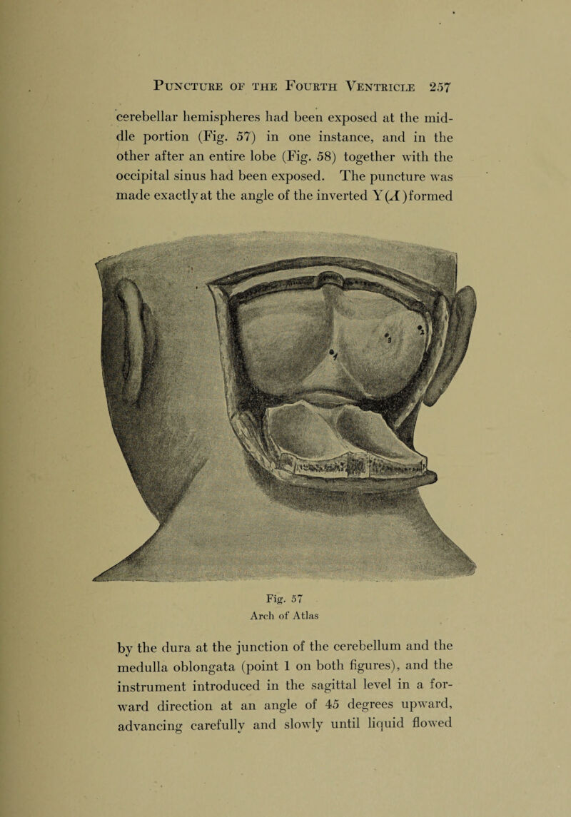 cerebellar hemispheres had been exposed at the mid¬ dle portion (Fig. 57) in one instance, and in the other after an entire lobe (Fig. 58) together with the occipital sinus had been exposed. The puncture was made exactly at the angle of the inverted Y(T) formed Fig. 57 Arch of Atlas by the dura at the junction of the cerebellum and the medulla oblongata (point 1 on both figures), and the instrument introduced in the sagittal level in a for¬ ward direction at an angle of 45 degrees upward, advancing carefully and slowly until liquid flowed