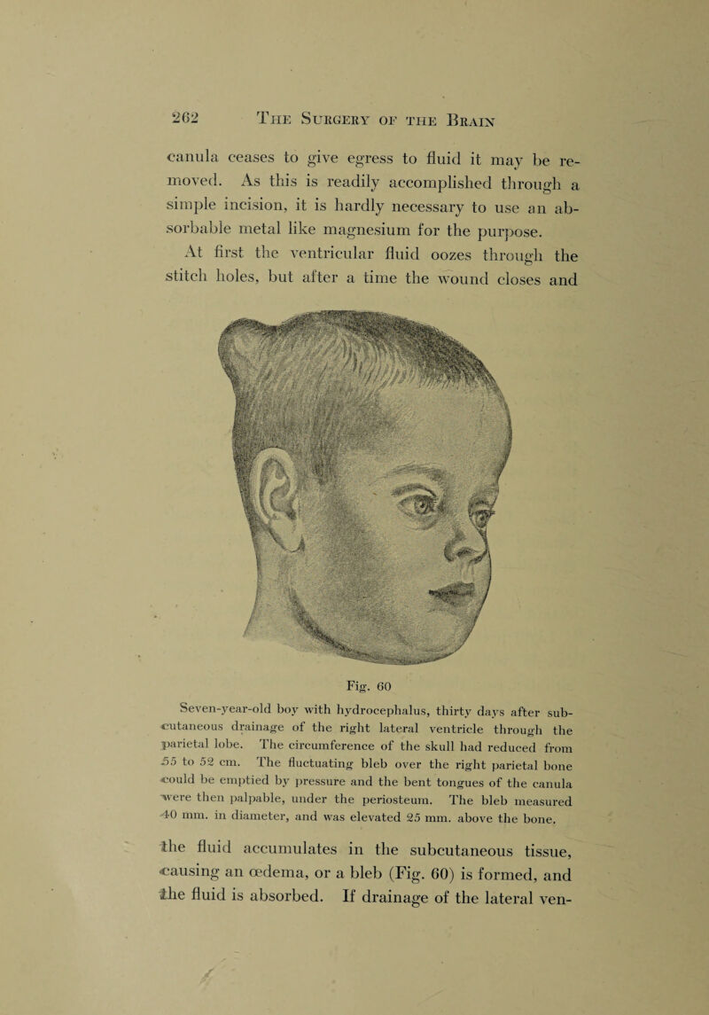 canula ceases to give egress to fluid it may be re¬ moved. As this is readily accomplished through a simple incision, it is hardly necessary to use an ab¬ sorbable metal like magnesium for the purpose. At first the ventricular fluid oozes through, the stitch holes, but after a time the wound closes and Fig. 60 Seven-year-old boy with hydrocephalus, thirty days after sub¬ cutaneous drainage of the right lateral ventricle through the parietal lobe. The circumference of the skull had reduced from 55 to 52 cm. The fluctuating bleb over the right parietal bone could be emptied by pressure and the bent tongues of the canula ’weie then palpable, under the periosteum. The bleb measured -40 mm. in diameter, and was elevated 25 mm. above the bone. the fluid accumulates in the subcutaneous tissue, -causing an oedema, or a bleb (Fig. 60) is formed, and the fluid is absorbed. If drainage of the lateral ven-