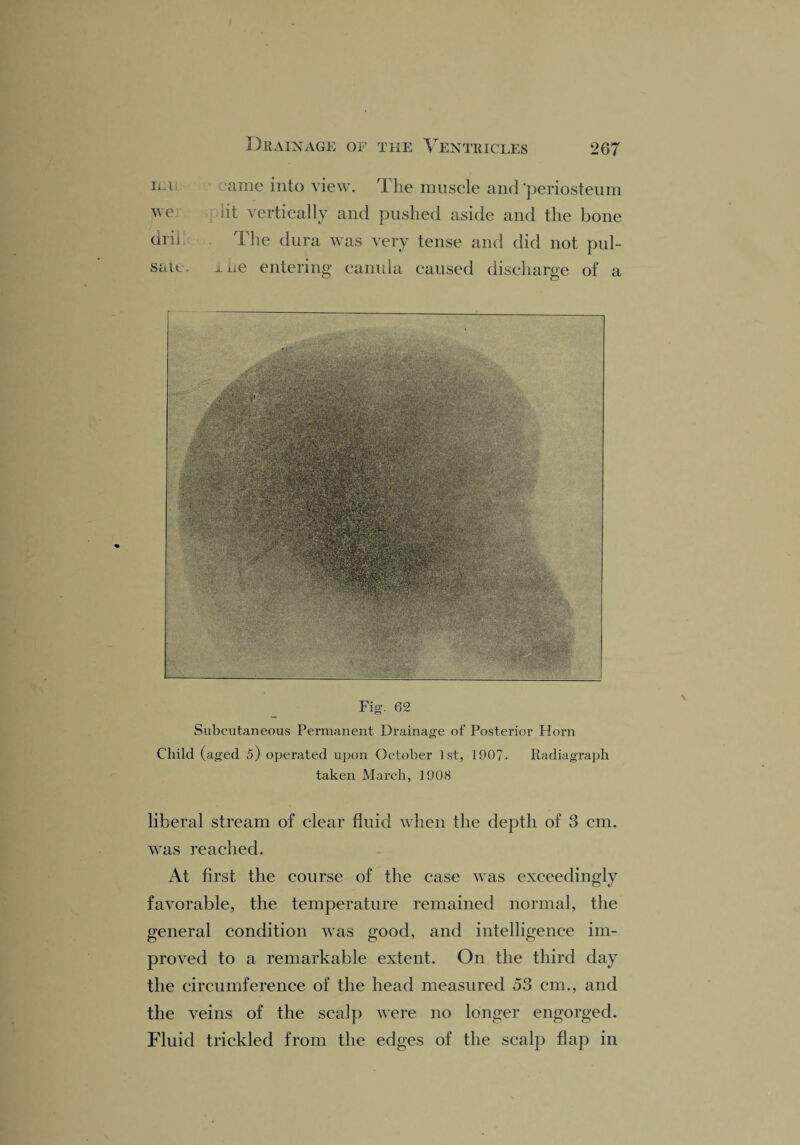 ill ame into view. The muscle and'periosteum we lit vertically and pushed aside and the bone drii The dura was very tense and did not pul¬ sate. mie entering canula caused discharge of a Fig. 62 Subcutaneous Permanent Drainage of Posterior Horn Child (aged 5) operated upon October 1st, 1907. Radiagraph taken March, 1908 liberal stream of clear fluid when the depth of 3 cm. was reached. At first the course of the case was exceedingly favorable, the temperature remained normal, the general condition was good, and intelligence im¬ proved to a remarkable extent. On the third day the circumference of the head measured 53 cm., and the veins of the scalp were no longer engorged. Fluid trickled from the edges of the scalp flap in