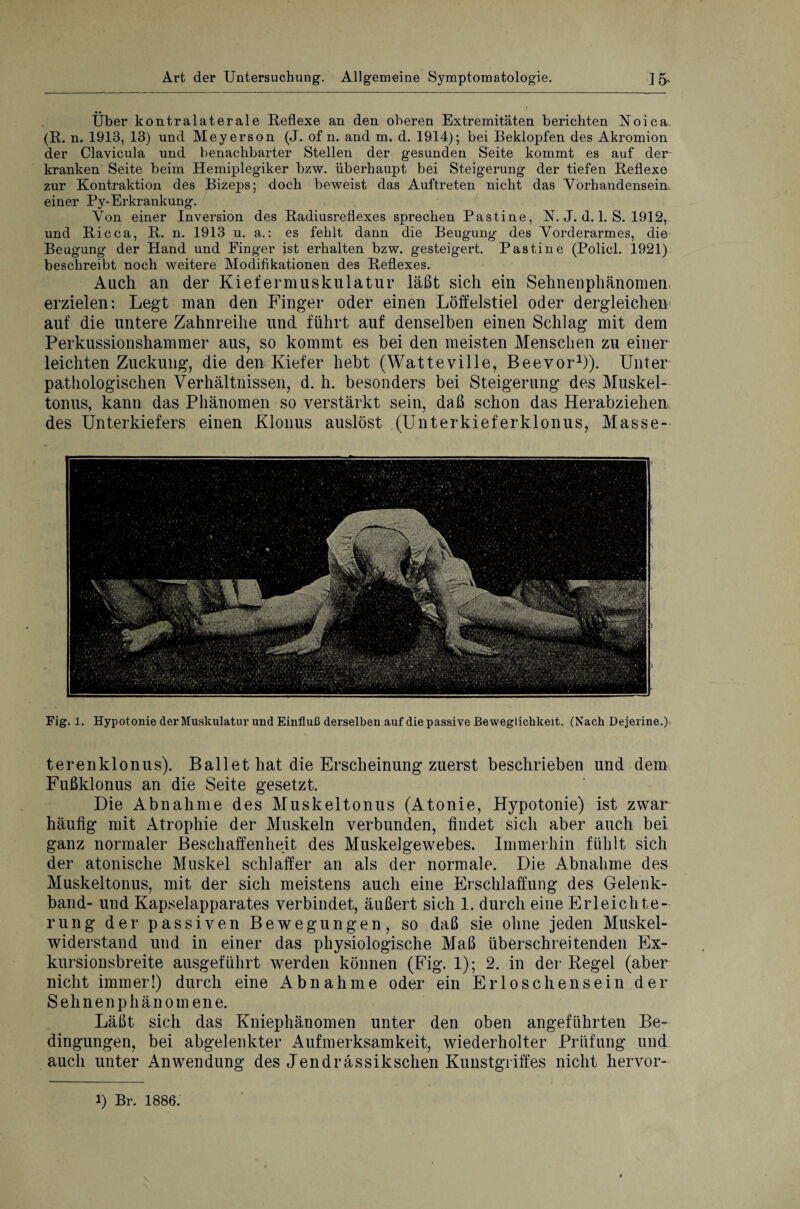 Über kontralaterale Reflexe an den oberen Extremitäten berichten ÜSToica (R. n. 1913, 13) und Meyerson (J. of n. and m. d. 1914); bei Beklopfen des Akromion der Clavicula und benachbarter Stellen der gesunden Seite kommt es auf der kranken Seite beim Hemiplegiker bzw. überhaupt bei Steigerung der tiefen Reflexe zur Kontraktion des Bizeps; doch beweist das Auftreten nicht das Vorhandensein, einer Py-Erkrankung. Von einer Inversion des Radiusreflexes sprechen Pastine, N. J. d. 1. S. 1912, und Ricca, R. n. 1913 u. a.: es fehlt dann die Beugung des Vorderarmes, die Beugung der Hand und Finger ist erhalten bzw. gesteigert. Pastine (Policl. 1921) beschreibt noch weitere Modifikationen des Reflexes. Auch an der Kiefermuskulatur läßt sich ein Sehnenphänomen erzielen: Legt man den Finger oder einen Löffelstiel oder dergleichen- auf die untere Zahnreihe und führt auf denselben einen Schlag mit dem Perkussionshammer aus, so kommt es bei den meisten Menschen zu einer leichten Zuckung, die den Kiefer hebt (Watteville, Beevor1)). Unter pathologischen Verhältnissen, d. h. besonders bei Steigerung des Muskel¬ tonus, kann das Phänomen so verstärkt sein, daß schon das Herabziehem des Unterkiefers einen Klonus auslöst (Unterkieferklonus, Masse- Flg. 1. Hypotonie der Muskulatur und Einfluß derselben auf die passive Beweglichkeit. (Nach Dejerine.) terenklonus). Ballet hat die Erscheinung zuerst beschrieben und dem Fußklonus an die Seite gesetzt. Die Abnahme des Muskeltonus (Atonie, Hypotonie) ist zwar häufig mit Atrophie der Muskeln verbunden, findet sich aber auch bei ganz normaler Beschaffenheit des Muskelgewebes. Immerhin fühlt sich der atonische Muskel schlaffer an als der normale. Die Abnahme des Muskeltonus, mit der sich meistens auch eine Erschlaffung des Gelenk¬ band- und Kapselapparates verbindet, äußert sich 1. durch eine Erleichte¬ rung der passiven Bewegungen, so daß sie ohne jeden Muskel¬ widerstand und in einer das physiologische Maß überschreitenden Ex¬ kursionsbreite ausgeführt werden können (Fig. 1); 2. in der Regel (aber nicht immer!) durch eine Abnahme oder ein Erloschensein der Sehnen phänomene. Läßt sich das Kniephänomen unter den oben angeführten Be¬ dingungen, bei abgelenkter Aufmerksamkeit, wiederholter Prüfung und auch unter Anwendung des Jendrässikschen Kunstgriffes nicht hervor- l) Br. 1886.