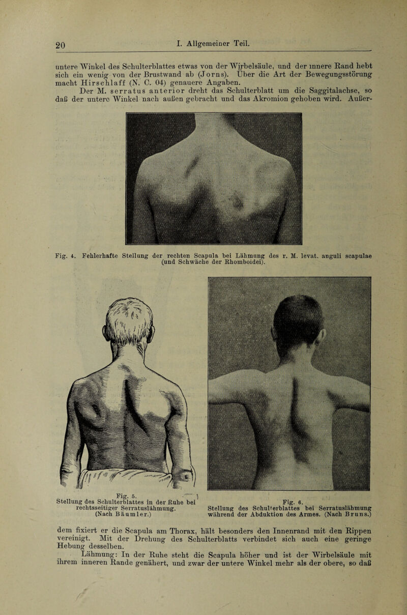 untere Winkel des Schulterblattes etwas von der Wirbelsäule, und der innere Rand hebt sich ein wenig von der Brustwand ab (Jorns). Über die Art der Bewegungsstörung macht Hirse hl aff (N. C. 04) genauere Angaben. Der M. serratus anterior dreht das Schulterblatt um die Saggitalachse, so daß der untere Winkel nach außen gebracht und das Akromion gehoben wird. Außer- Fig. 4. Fehlerhafte Stellung der rechten Scapula hei Lähmung des r. M. levat. anguli scapulae (und Schwäche der Rhomboidei). Fig. 5. ^ Stellung des Schulterblattes in der Ruhe bei Fig. 6. rechtsseitiger Serratuslähmung. Stellung des Schulterblattes bei Serratuslähmung (Nach Bä um ler.) während der Abduktion des Armes. (Nach Bruns.) dem fixiert er die Scapula am Thorax, hält besonders den Innenrand mit den Rippen vereinigt. Mit der Drehung des Schulterblatts verbindet sich auch eine geringe Hebung desselben. Lähmung: In der Ruhe steht die Scapula höher und ist der Wirbelsäule mit ihrem inneren Rande genähert, und zwar der untere Winkel mehr als der obere, so daß