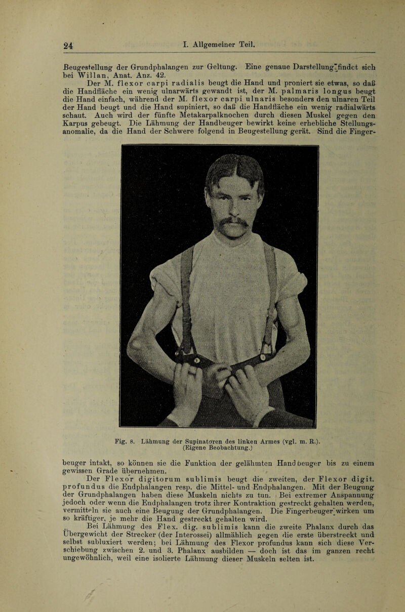 .Beugestellung der Grundphalangen zur Geltung. Eine genaue Darstellunglfindet sich bei Will an, Anat. Anz. 42. Der M. flexor carpi radialis beugt die Hand und proniert sie etwas, so daß die Handfläche ein wenig ulnarwärts gewandt ist, der M. palmaris longus beugt die Hand einfach, während der M. flexor carpi ulnaris besonders den ulnaren Teil der Hand beugt und die Hand supiniert, so daß die Handfläche ein wenig radialwärts schaut. Auch wird der fünfte Metakarpalknochen durch diesen Muskel gegen den Karpus gebeugt. Die Lähmung der Handbeuger bewirkt keine erhebliche Stellungs¬ anomalie, da die Hand der Schwere folgend in Beugestellung gerät. Sind die Finger- Fig. 8. Lähmung cler Supinatoren des linken Armes (vgl. m. R.). (Eigene Beobachtung.) beuger intakt, so können sie die Funktion der gelähmten Handbeuger bis zu einem gewissen Grade übernehmen. Der Flexor digitorum sublimis beugt die zweiten, der Flexor digit. profundus die Endphalangen resp. die Mittel-und Endphalangen. Mit der Beugung der Grundphalangen haben diese Muskeln nichts zu tun. Bei extremer Anspannung jedoch oder wenn die Endphalangen trotz ihrer Kontraktion gestreckt gehalten werden, vermitteln sie auch eine Beugung der Grundphalangen. Die Fingerbeuger'wirken um so kräftiger, je mehr die Hand gestreckt gehalten wird. Bei Lähmung des Flex. dig. sublimis kann die zweite Phalanx durch das Übergewicht der Strecker (der Interossei) allmählich gegen die erste überstreckt und selbst subluxiert werden; bei Lähmung des Flexor profundus kann sich diese Ver¬ schiebung zwischen 2. und 3. Phalanx ausbilden — doch ist das im ganzen recht ungewöhnlich, weil eine isolierte Lähmung dieser Muskeln selten ist.