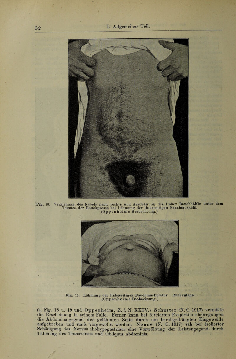 Fig. 18. Verziehung des Nabels nach rechts und Ausdehnung der linken Bauchhälfte unter dem Versucu der Bauchpresse bei Lähmung der linksseitigen Bauchmuskeln. (Oppenheims Beobachtung.) Fig. 19. Lähmung der linksseitigen Bauchmuskulatur. Bückenlage. (Oppenheims Beobachtung.) (s. Fig. 18 u. 19 und Oppenheim, Z. f. N. XXIV.) Schuster (N. C. 1917) vermißte die Erscheinung in seinem Falle. Ferner kann bei forcierten Exspirationsbewegungen die Abdominalgegend der gelähmten Seite durch die herabgedrängten Eingeweide aufgetrieben und stark vorgewölbt werden. Nonne (N. 0.1917) sah bei isolierter Schädigung des Nervus iliohypogastricus eine Vorwölbung der Leistengegend durch Lähmung des Transversus und Obliquus abdominis.