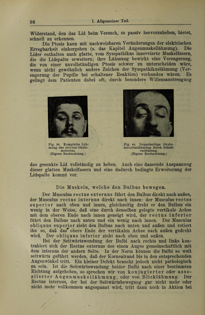 Widerstand, den das Lid beim Versuch, es passiv hervorzuheben, bietet, schnell zu erkennen. Die Ptosis kann mit nachweisbaren Veränderungen der elektrischen Erregbarkeit einhergehen (s. das Kapitel Augenmuskellähmung). Die Lider enthalten auch glatte, vom Sympathikus innervierte Muskelfasern, die die Lidspalte erweitern; ihre Lähmung bewirkt eine Verengerung, die von einer unvollständigen Ptosis schwer zu unterscheiden wäre, wenn nicht gewöhnlich andere Zeichen der Sympathikuslähmung (Ver¬ engerung der Pupille bei erhaltener Reaktion) vorhanden wären. Es gelingt dem Patienten dabei oft, durch besondere Willensanstrengung i Fig. 39. Komplette Läh¬ mung des rechten Okulo- motorius. (Eigene Beobachtung.) Fig. 40. Doppelseitige Okulo¬ motoriuslähmung durch Schuß¬ verletzung. (Eigene Beobachtung.) das gesenkte Lid vollständig zu heben. Auch eine dauernde Anspannung dieser glatten Muskelfasern und eine dadurch bedingte Erweiterung der Lidspalte kommt vor. Die Muskeln, welche den Bulbus bewegen. Der Musculus rectus externus führt den Bulbus direkt nach außen, der Musculus rectus internus direkt nach innen: der Musculus rectus superior nach oben und innen, gleichzeitig dreht er den Bulbus ein wenig in der Weise, daß eine durch denselben gelegte vertikale Achse mit dem oberen Ende nach innen geneigt wird, der rectus inferior führt den Bulbus nach unten und ein wenig nach innen. Der Musculus obliquus superior zieht den Bulbus nach unten und außen und rotiert ihn so, daß das* obere Ende der vertikalen Achse nach außen gedreht wird. Der obliquus inferior zieht nach oben und außen. Bei der Seitwärtswendung der Bulbi nach rechts und links kon¬ trahiert sich der Rectus externus des einen Auges gemeinschaftlich mit dem internus der andern Seite. In der Norm können die Bulbi so weil seitwärts geführt werden, daß der Kornealrand bis in den entsprechenden Augenwinkel tritt. Ein kleiner Defekt braucht jedoch nicht pathologisch zu sein. Ist die Seitwärtswendung beider Bulbi nach einer bestimmten Richtung aufgehoben, so sprechen wir von konjugierter oder asso¬ ziierter Augenmuskellähmung, oder von Blicklähmung. Der Rectus internus, der bei der Seitwärtsbewegung gar nicht mehr oder nicht mehr vollkommen angespannt wird, tritt dann noch in Aktion bei