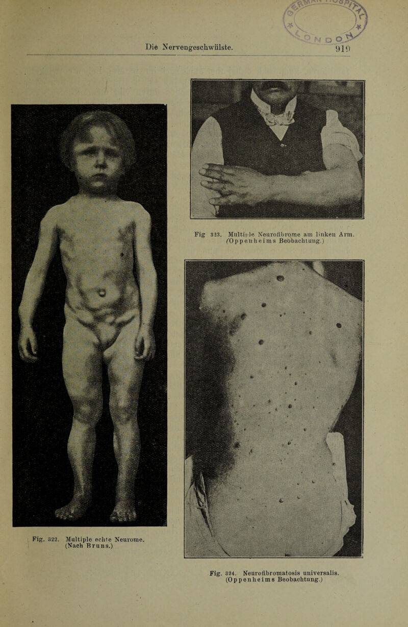 Fig. 824. Neurofibromatosis universalis. (Oppenheims Beobachtung.)