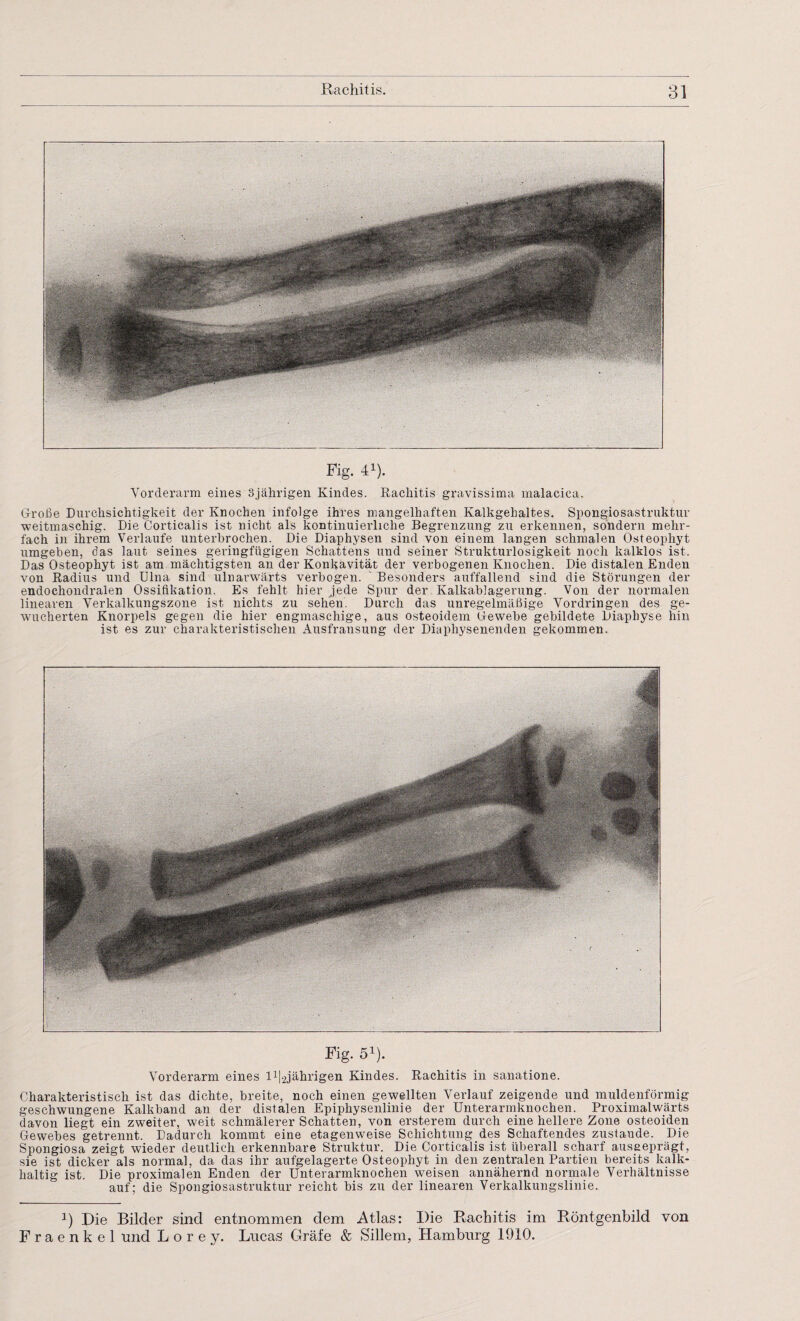 Fig. 41). Vorderarm eines 3jährigen Kindes. Rachitis gravissima malacica. Große Durchsichtigkeit der Knochen infolge ihres mangelhaften Kalkgehaltes. Spongiosastruktur weitmaschig. Die Corticalis ist nicht als kontinuierliche Begrenzung zu erkennen, sondern mehr¬ fach in ihrem Verlaufe unterbrochen. Die Diaphysen sind von einem langen schmalen Osteophyt umgeben, das laut seines geringfügigen Schattens und seiner Strukturlosigkeit noch kalklos ist. Das Osteophyt ist am mächtigsten an der Konkavität der verbogenen Knochen. Die distalen Enden von Radius und Ulna sind ulnarwärts verbogen. Besonders auffallend sind die Störungen der endochondralen Ossifikation. Es fehlt hier jede Spur der Kalkablagerung. Von der normalen linearen Verkalkungszone ist nichts zu sehen. Durch das unregelmäßige Vordringen des ge¬ wucherten Knorpels gegen die hier engmaschige, aus osteoidem Gewebe gebildete Diaphyse hin ist es zur charakteristischen Ausfransung der Diaphysenenden gekommen. Fig. 51). Vorderarm eines Id^jährigen Kindes. Rachitis in sanatione. Charakteristisch ist das dichte, breite, noch einen gewellten Verlauf zeigende und muldenförmig geschwungene Kalkband an der distalen Epiphysenlinie der Unterarmknochen. Proximalwärts davon liegt ein zweiter, weit schmälerer Schatten, von ersterem durch eine hellere Zone osteoiden Gewebes getrennt. Dadurch kommt eine etagenweise Schichtung des Schaftendes zustande. Die Spongiosa zeigt wieder deutlich erkennbare Struktur. Die Corticalis ist überall scharf ausgeprägt, sie ist dicker als normal, da das ihr aufgelagerte Osteophyt in den zentralen Partien bereits kalk¬ haltig ist. Die proximalen Enden der Unterarmknochen weisen annähernd normale Verhältnisse auf; die Spongiosastruktur reicht bis zu der linearen Verkalkungslinie. 3) Die Bilder sind entnommen dem Atlas: Die Rachitis im Röntgenbild von F r a e n k e 1 und L o r e y. Lncas Gräfe & Sillem, Hamburg 1910.
