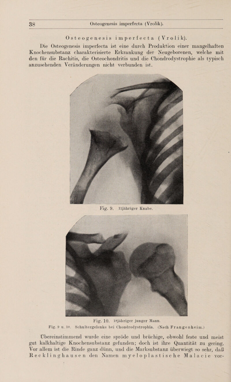 Osteogenesis imperfecta (Vrolik). Die Osteogenesis imperfecta ist eine durch Produktion einer mangelhaften Knochensubstanz charakterisierte Erkrankung der Neugeborenen, welche mit den für die Rachitis, die Osteochondritis und die Chondrodystrophie als typisch anzusehenden Veränderungen nicht verbunden ist. Fig. 9, lljähriger Knabe. Fig. 10. lSjähriger junger Mann. Fig. 9 u. 10. Schultergelenke bei Chondrodystrophia. (Nach Frangenheim.) Übereinstimmend wurde eine spröde und brüchige, obwohl feste und meist gut kalkhaltige Knochensubstanz gefunden; doch ist ihre Quantität zu gering. Vor allem ist die Rinde ganz dünn, und die Marksubstanz überwiegt so sehr, daß Recklinghausen den Namen myeloplastische M a 1 a c i e vor-