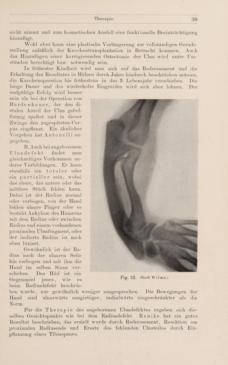 sicht nimmt und zum kosmetischen Ausfall eine funktionelle Beeinträchtigung o o hinzufügt. Wohl aber kann eine plastische Verlängerung zur vollständigen Gerade¬ stellung anläßlich der Knochentransplantation in Betracht kommen. Auch das Hinzufügen einer korrigierenden Osteotomie der Ulna wird unter Um¬ ständen berechtigt bzw. notwendig sein. In frühester Kindheit wird man sich auf das Kedressement und die Erhaltung des Kesultates in Hülsen durch Jahre hindurch beschränken müssen, die Knochenoperation bis frühestens in das 3. Lebensjahr verschieben. Die lange Dauer und das wiederholte Eingreifen wird sich aber lohnen. Der endgültige Erfolg wird besser sein als bei der Operation von Ba,rdenheuer, der den di¬ stalen Anteil der Ulna gabel¬ förmig spaltet und in dieser Zwinge den zugespitzten Car- pus einpflanzt. Ein ähnliches Vorgehen hat Antonelli an¬ gegeben. B. Auch bei angeborenem Ulnadefekt findet man gleichzeitiges Vorkommen an¬ derer Verbildungen. Er kann ebenfalls ein totaler oder ein partieller sein, wobei das obere, das untere oder das mittlere Stück fehlen kann. Dabei ist der Kadius normal oder verbogen, von der Hand fehlen ulnare Finger oder es besteht Ankylose des Humerus mit dem Kadius oder zwischen Kadius und einem vorhandenen proximalen Ulnafragment, oder der isolierte Kadius ist nach oben luxiert. Gewöhnlich ist der Ka¬ dius nach der ulnaren Seite hin verbogen und mit ihm die Hand im selben Sinne ver¬ schoben. Das Bild ist ein Gegenspiel jenes, wie es beim Radiusdefekt beschrie¬ ben wurde, nur gewöhnlich weniger ausgesprochen. Die Bewegungen der Hand sind ulnarwärts ausgiebiger, radialwärts eingeschränkter als die Horm. Für die Therapie des angeborenen Ulnadefektes ergeben sich die¬ selben Gesichtspunkte wie bei dem Radiusdefekt. Renike hat ein gutes Resultat beschrieben, das erzielt wurde durch Kedressement, Resektion am proximalen Radiusende und Ersatz des fehlenden Ulnateiles durch Ein¬ pflanzung eines Tibiaspanes. Fig. 33. (Nach Wilms.)