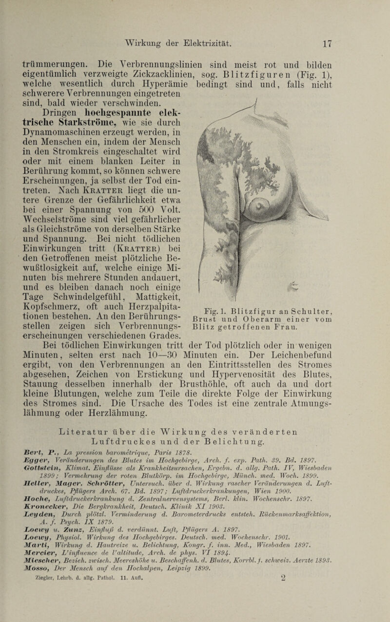 trümmerungen. Die Verbrennungslinien sind meist rot und bilden eigentümlich verzweigte Zickzacklinien, sog. Blitzfiguren (Fig. 1), welche wesentlich durch Hyperämie bedingt sind und, falls nicht schwerere Verbrennungen eingetreten sind, bald wieder verschwinden. Dringen hochgespannte elek¬ trische Starkströme, wie sie durch Dynamomaschinen erzeugt werden, in den Menschen ein, indem der Mensch in den Stromkreis eingeschaltet wird oder mit einem blanken Leiter in Berührung kommt, so können schwere Erscheinungen, ja selbst der Tod ein- treten. Nach Kratter liegt die un¬ tere Grenze der Gefährlichkeit etwa bei einer Spannung von 500 Volt. Wechselströme sind viel gefährlicher als Gleichströme von derselben Stärke und Spannung. Bei nicht tödlichen Einwirkungen tritt (Kratter) bei den Getroffenen meist plötzliche Be¬ wußtlosigkeit auf, welche einige Mi¬ nuten bis mehrere Stunden andauert, und es bleiben danach noch einige Tage Schwindelgefühl, Mattigkeit, Kopfschmerz, oft auch Herzpalpita- tionen bestehen. An den Berührungs¬ stellen zeigen sich Verbrennungs- erscheinungen verschiedenen Grades. Bei tödlichen Einwirkungen tritt der Tod plötzlich oder in wenigen Minuten, selten erst nach 10—30 Minuten ein. Der Leichenbefund ergibt, von den Verbrennungen an den Eintrittsstellen des Stromes abgesehen, Zeichen von Erstickung und Hypervenosität des Blutes, Stauung desselben innerhalb der Brusthöhle, oft auch da und dort kleine Blutungen, welche zum Teile die direkte Folge der Einwirkung des Stromes sind. Die Ursache des Todes ist eine zentrale Atmungs¬ lähmung oder Herzlähmung. Fig. 1. Blitzfigur an Schulter, Brust und Oberarm einer vom Blitz getroffenen Frau. Literatur über die Wirkung des veränderten Luftdruckes und der Belichtung. Bert, P., La pression barometrique, Paris 1878. Egger, Veränderungen des Blutes im Hochgebirge, Arch. f. exp. Path. 89. Bd. 1897. Gottstein, Klimat. Einflüsse als Krankheitsursachen, Ergehn, d. allg. Path. IV, Wiesbaden 1899; Vermehrung der roten Blutkörp. im Hochgebirge, Münch, med. Woch. 1899. Heller, Mager. Schrötter, Untersuch, über d. Wirkung rascher Veränderungen d. Luft¬ druckes, Pflügers Arcli. 67. Bd. 1897; Luftdruckerkrankungen, Wien 1900. Hoclie, Luftdruckerkrankung d. Zentralnervensystems, Berl. klin. Wochenschr. 1897. Kroneckev, Die Bergkrankheit, Deutsch. Klinik XI 1903. Leyden, Durch plötzl. Verminderunq d. Barometer drucks entsteh. Rückenmarksaffektion, A. f. Psych. IX 1879. Loewy u. Zunz, Einfluß d. verdünnt. Luft, Pflügers A. 1897. Loeivy, Physiol. Wirkung des Hochgebirges. Deutsch, med. Wochenschr. 1901. Marti, Wirkung d. Hautreize u. Belichtung, Kongr. f. inn. Med., Wiesbaden 1897. ATercier, L’influence de Valtitude, Arch. de phys. VI 189Jf. Miescher, Bezieh, zwisch. Meereshöhe u. Beschaffenh. d. Blutes, Korrbl.f. Schweiz. Aerzte 1893. Mosso, Der Mensch auf den Hochalpen, Leipzig 1899. Ziegler, I.ehrb. d. allg. Pathol. 11. Aufl. 2