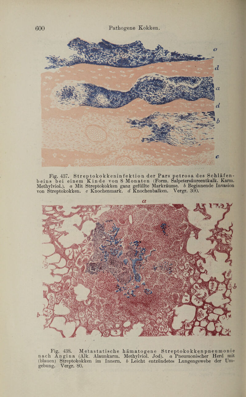 c Fig. 437. Streptokokkeninfektion der Pars petrosa des Schläfen¬ beins bei einem Kinde von 8 Monaten (Form. Salpetersäureentkalk. Karm. Methylviol.). a Mit Streptokokken ganz gefüllte Markräume, b Beginnende Invasion von Streptokokken, c Knochenmark, d Knochenbalken. Yergr. 300. Fig. 438. Metastatische hämatogene Streptokokkenpneumonie nach Angina (Alk. Alaunkarm. Methylviol. Jod), a Pneumonischer Herd mit (blauen) Streptokokken im Innern, b Leicht entzündetes Lungengewebe der Um¬ gebung. Yergr. 80.