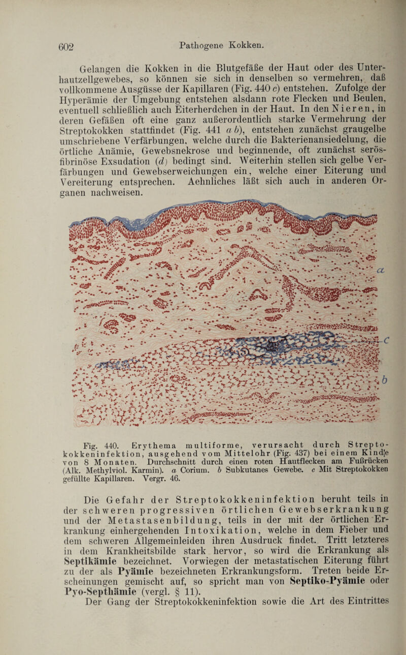 Gelangen die Kokken in die Blutgefäße der Haut oder des Unter¬ hautzellgewebes, so können sie sich in denselben so vermehren, daß vollkommene Ausgüsse der Kapillaren (Fig. 440 c) entstehen. Zufolge der Hyperämie der Umgebung entstehen alsdann rote Flecken und Beulen, eventuell schließlich auch Eiterherdchen in der Haut. In den Nieren, in deren Gefäßen oft eine ganz außerordentlich starke Vermehrung der Streptokokken stattfindet (Fig. 441 ab), entstehen zunächst graugelbe umschriebene Verfärbungen, welche durch die Bakterienansiedelung, die örtliche Anämie, Gewebsnekrose und beginnende, oft zunächst serös¬ fibrinöse Exsudation (d) bedingt sind. Weiterhin stellen sich gelbe Ver¬ färbungen und Gewebserweichungen ein, welche einer Eiterung und Vereiterung entsprechen. Aelinliches läßt sich auch in anderen Or¬ ganen nachweisen. Fig. 440. Erythema multiforme, verursacht durch Strepto- kokkeninfektion, ausgehend vom Mittelohr (Fig. 437) bei einem Kindje von 8 Monaten. Durchschnitt durch einen roten Hautflecken am Fußrücken (Alk. Methylviol. Karmin), a Corium. b Subkutanes Gewebe, c Mit Streptokokken gefüllte Kapillaren. Vergr. 46. Die Gefahr der Streptokokkeninfektion beruht teils in der schweren progressiven örtlichen Gewebserkrankung und der Metastasenbildung, teils in der mit der örtlichen Er¬ krankung einhergehenden Intoxikation, welche in dem Fieber und dem schweren Allgemeinleiden ihren Ausdruck findet. Tritt letzteres in dem Krankheitsbilde stark hervor, so wird die Erkrankung als Septikämie bezeichnet. Vorwiegen der metastatischen Eiterung führt zu der als Pyämie bezeichneten Erkrankungsform. Treten beide Er¬ scheinungen gemischt auf, so spricht man von Septiko-Pyämie oder Pyo-Septliämie (vergl. § 11). Der Gang der Streptokokkeninfektion sowie die Art des Eintrittes