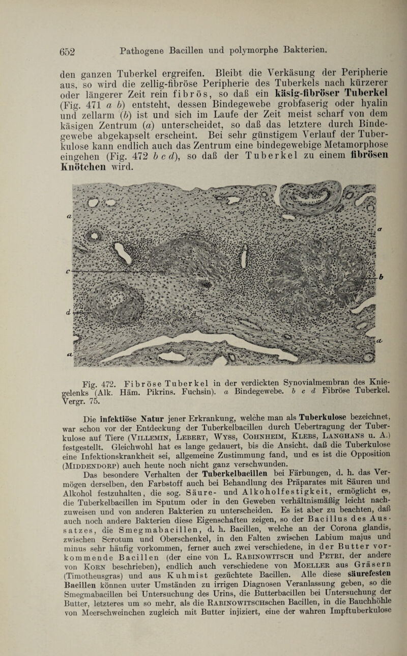 den ganzen Tuberkel ergreifen. Bleibt die Verkäsung der Peripherie aus, so wird die zeilig-fibröse Peripherie des Tuberkels nach kürzerer oder längerer Zeit rein fibrös, so daß ein käsig-fibröser Tuberkel (Fig. 471 a b) entsteht, dessen Bindegewebe grobfaserig oder hyalin und zellarm (b) ist und sich im Laufe der Zeit meist scharf von dem käsigen Zentrum (a) unterscheidet, so daß das letztere durch Binde¬ gewebe ab gekapselt erscheint. Bei sehr günstigem Verlauf der Tuber¬ kulose kann endlich auch das Zentrum eine bindegewebige Metamorphose eingehen (Fig. 472 b c d), so daß der Tuberkel zu einem fibrösen Knötchen wird. Fig. 472. Fibröse Tuberkel in der verdickten Synovialmembran des Knie¬ gelenks °(Alk. Häm. Pikrins. Fuchsin), a Bindegewebe, b c d Fibröse Tuberkel. Vergr. 75. Die infektiöse Natur jener Erkrankung, welche man als Tuberkulose bezeichnet, war schon vor der Entdeckung der Tuberkelbacillen durch Uebertragung der Tuber¬ kulose auf Tiere (Villemin, Lebert, Wyss, Cohnheim, Klebs, Langhans u. A.) festgestellt. Gleichwohl hat es lange gedauert, bis die Ansicht, daß die Tuberkulose eine Infektionskrankheit sei, allgemeine Zustimmung fand, und es ist die Opposition (Middendorp) auch heute noch nicht ganz verschwunden. Das besondere Verhalten der Tuberkelbacillen bei Färbungen, d. h. das Ver¬ mögen derselben, den Farbstoff auch bei Behandlung des Präparates mit Säuren und Alkohol festzuhalten, die sog. Säure- und Alkoholfestigkeit, ermöglicht es, die Tuberkelbacillen im Sputum oder in den Geweben verhältnismäßig leicht nach¬ zuweisen und von anderen Bakterien zu unterscheiden. Es ist aber zu beachten, daß auch noch andere Bakterien diese Eigenschaften zeigen, so der Bacillus des Aus¬ satzes, die Smegmabacillen, d. h. Bacillen, welche an der Corona glandis, zwischen Scrotum und Oberschenkel, in den Falten zwischen Labium majus und minus sehr häufig Vorkommen, ferner auch zwei verschiedene, in der Butter vor¬ kommende Bacillen (der eine von L. Rabinowitsch und Petri, der andere von Korn beschrieben), endlich auch verschiedene von Moeller aus Gräsern (Timotheusgras) und aus Kuhmist gezüchtete Bacillen. Alle diese säurefesteil Bacillen können unter Umständen zu irrigen Diagnosen Veranlassung geben, so die Smegmabacillen bei Untersuchung des Urins, die Butterbacillen bei Untersuchung der Butter, letzteres um so mehr, als die RABiNOWiTSCHschen Bacillen, in die Bauchhöhle von Meerschweinchen zugleich mit Butter injiziert, eine der wahren Impftuberkulose