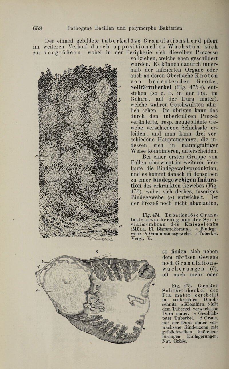 Der einmal gebildete tuberkulöse Granulationsherd pflegt im weiteren Verlauf durch appositionelles Wachstum sich zu vergrößern, wobei in der Peripherie sich dieselben Prozesse vollziehen, welche eben geschildert wurden. Es können dadurch inner¬ halb der infizierten Organe oder auch an deren Oberfläche Knoten von bedeutender Größe, Solitärtuberkel (Fig. 475 c), ent¬ stehen (so z. B. in der Pia, im Gehirn, auf der Dura mater), welche wahren Geschwülsten ähn¬ lich sehen. Im übrigen kann das durch den tuberkulösen Prozeß veränderte, resp. neugebildete Ge¬ webe verschiedene Schicksale er¬ leiden , und man kann drei ver¬ schiedene Hauptausgänge, die in¬ dessen sich in mannigfaltiger Weise kombinieren, unterscheiden. Bei einer ersten Gruppe von Fällen überwiegt im weiteren Ver¬ laufe die Bindegewebsproduktion, und es kommt danach in denselben zu einer bindegewebigen Indura¬ tion des erkrankten Gewebes (Fig. 476), wobei sich derbes, faseriges Bindegewebe (a) entwickelt. Ist der Prozeß noch nicht abgelaufen, Fig. 474. Tuberkulöse Granu¬ lationswucherung aus der Syno¬ vialmembran des Kniegelenks (Müll. Fl. Bismarckbraun), a Bindege¬ webe. ' b Granulationsgewebe, c Tuberkel. Vergr. 80. so finden sich neben dem fibrösen Gewebe noch Granulations¬ wucherungen (b), oft auch mehr oder Fig. 475. Großer Solitärtuberkel der Pia mater cerebelli im senkrechten Durch¬ schnitt. »Kleinhirn, b Mit dem Tuberkel venvachsene Dura mater. c Geschich¬ teter Tuberkel, d Graue, mit der Dura mater ver¬ wachsene Bindenzone mit gelblichweißen, knötchen¬ förmigen Einlagerungen. Nat. Größe.