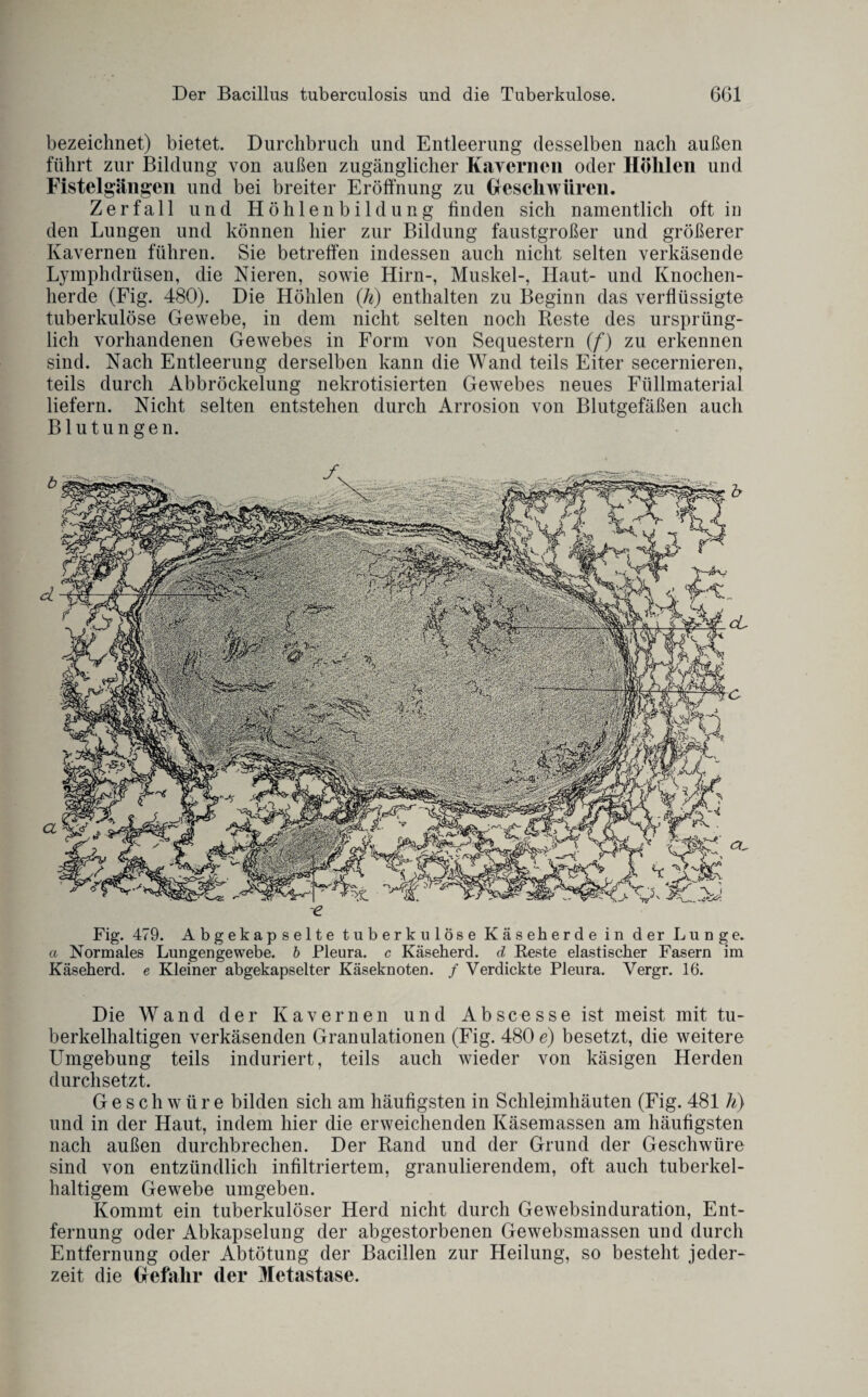 bezeichnet) bietet. Durchbruch und Entleerung desselben nach außen führt zur Bildung von außen zugänglicher Kavernen oder Höhlen und Fistelgäiigen und bei breiter Eröffnung zu Geschwüren. Zerfall und Höhlenbildung finden sich namentlich oft in den Lungen und können hier zur Bildung faustgroßer und größerer Kavernen führen. Sie betreffen indessen auch nicht selten verkäsende Lymphdrüsen, die Nieren, sowie Hirn-, Muskel-, Haut- und Knochen¬ herde (Fig. 480). Die Höhlen (A) enthalten zu Beginn das verflüssigte tuberkulöse Gewebe, in dem nicht selten noch Reste des ursprüng¬ lich vorhandenen Gewebes in Form von Sequestern (f) zu erkennen sind. Nach Entleerung derselben kann die Wand teils Eiter secernieren, teils durch Abbröckelung nekrotisierten Gewebes neues Füllmaterial liefern. Nicht selten entstehen durch Arrosion von Blutgefäßen auch Blutungen. -e Fig. 479. Abgekapselte tuberkulöse Käseherde in der Lunge. a Normales Lungengewebe, b Pleura, c Käseherd, d Reste elastischer Fasern im Käseherd, e Kleiner abgekapselter Käseknoten. / Verdickte Pleura. Vergr. 16. Die Wand der Kavernen und A b s c e s s e ist meist mit tu¬ berkelhaltigen verkäsenden Granulationen (Fig. 480 e) besetzt, die weitere Umgebung teils induriert, teils auch wieder von käsigen Herden durchsetzt. Geschwüre bilden sich am häufigsten in Schleimhäuten (Fig. 481 A) und in der Haut, indem hier die erweichenden Käsemassen am häufigsten nach außen durchbrechen. Der Rand und der Grund der Geschwüre sind von entzündlich infiltriertem, granulierendem, oft auch tuberkel- haltigem Gewebe umgeben. Kommt ein tuberkulöser Herd nicht durch Gewebsinduration, Ent¬ fernung oder Abkapselung der abgestorbenen Gewebsmassen und durch Entfernung oder Abtötung der Bacillen zur Heilung, so besteht jeder¬ zeit die Gefahr der Metastase.