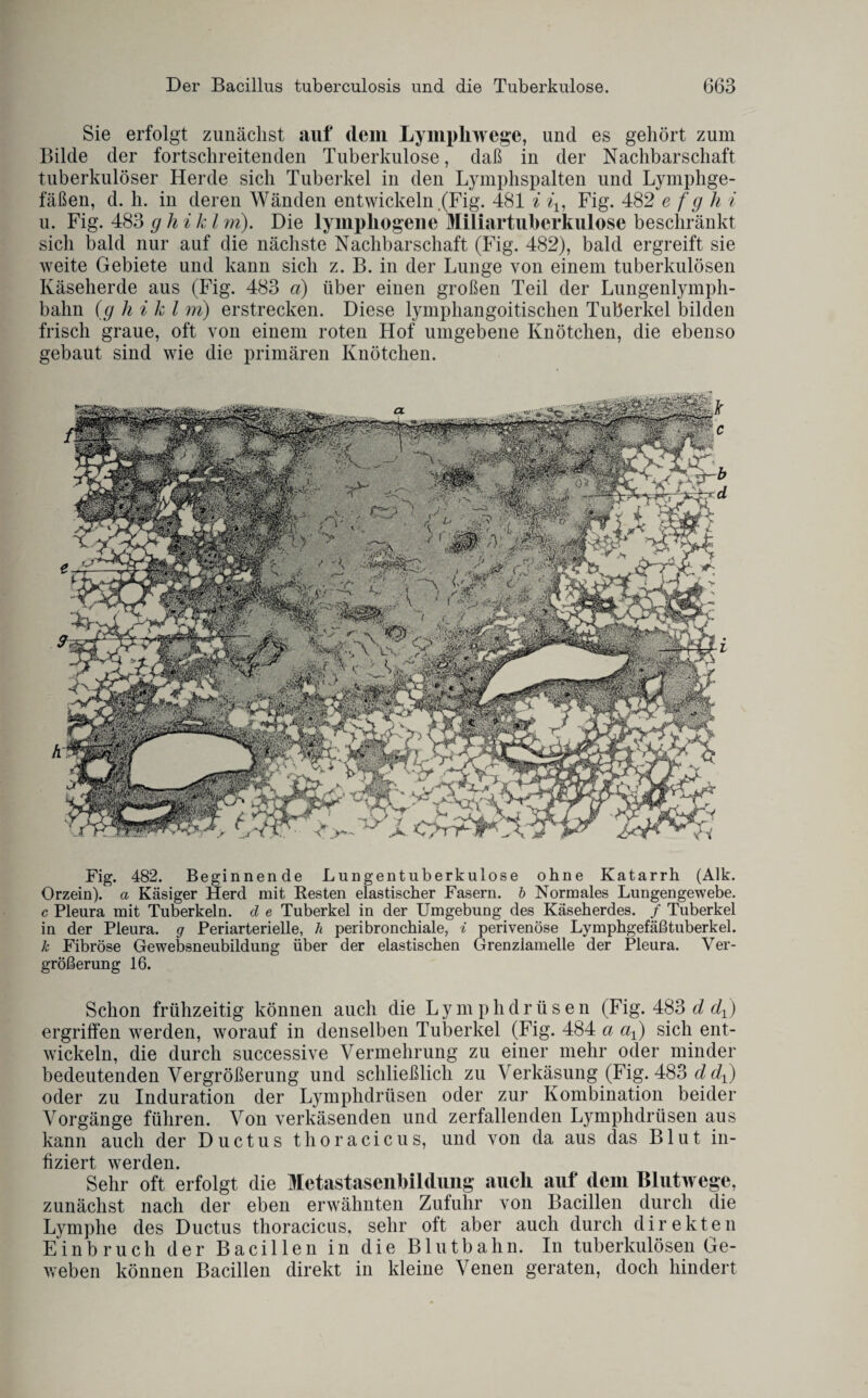 Sie erfolgt zunächst auf dem Lymphwege, und es gehört zum Bilde der fortschreitenden Tuberkulose, daß in der Nachbarschaft tuberkulöser Herde sich Tuberkel in den Lymphspalten und Lymphge¬ fäßen, d. h. in deren Wänden entwickeln (Fig. 481 i it, Fig. 482 e f g h i u. Fig. 483 g li i k l m). Die lyinphogene Miliartuberkulose beschränkt sich bald nur auf die nächste Nachbarschaft (Fig. 482), bald ergreift sie weite Gebiete und kann sich z. B. in der Lunge von einem tuberkulösen Käseherde aus (Fig. 483 a) über einen großen Teil der Lungenlymph- bahn (g h i k l m) erstrecken. Diese lymphangoitischen Tuberkel bilden frisch graue, oft von einem roten Hof umgebene Knötchen, die ebenso gebaut sind wie die primären Knötchen. Fig. 482. Beginnende Lungentuberkulose ohne Katarrh (Alk. Orzein), a Käsiger Herd mit Resten elastischer Fasern, b Normales Lungengewebe. c Pleura mit Tuberkeln, d e Tuberkel in der Umgebung des Käseherdes. / Tuberkel in der Pleura, g Periarterielle, h peribronchiale, i peri venöse Lymphgefäßtuberkel. k Fibröse Gewebsneubildung über der elastischen Grenziamelle der Pleura. Ver¬ größerung 16. Schon frühzeitig können auch die Lymphdrüsen (Fig. 483 d ergriffen werden, worauf in denselben Tuberkel (Fig. 484 a ax) sich ent¬ wickeln, die durch successive Vermehrung zu einer mehr oder minder bedeutenden Vergrößerung und schließlich zu Verkäsung (Fig. 483 d dj oder zu Induration der Lymphdrüsen oder zur Kombination beider Vorgänge führen. Von verkäsenden und zerfallenden Lymphdrüsen aus kann auch der Ductus thoracicus, und von da aus das Blut in¬ fiziert werden. Sehr oft erfolgt die MetastasenMdimg auch auf dem Blutwege, zunächst nach der eben erwähnten Zufuhr von Bacillen durch die Lymphe des Ductus thoracicus, sehr oft aber auch durch direkten Einbruch der Bacillen in die Blutbahn. In tuberkulösen Ge¬ weben können Bacillen direkt in kleine Venen geraten, doch hindert