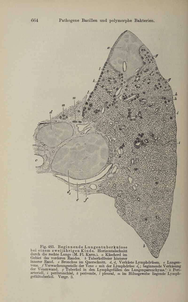 Fig. 483. Beginn ende Lungentuberkulose bei einem zweijährigen Kinde. Horizontalschnitt durch die rechte Lunge (M. Fl. Karm.). a Käseherd im Gebiet des vorderen Bandes, b Tuberkelfreier hinterer innerer Band, c Bronchus im Querschnitt, d, Verkäste Lymphdrüsen. e Lungen¬ vene. / Verwachsungsstelle der Vene e mit der Lymphdriise dt; beginnende Verkäsung der Venenwand. g Tuberkel in den Lymphgefäßen des Lungenparenchyms/^’/« Peri¬ arteriell, i peribronchial, k perivenös, l pleural, m im Hilusgewebe liegende Lvmph- gefäßtuberkel. Vergr. 3.