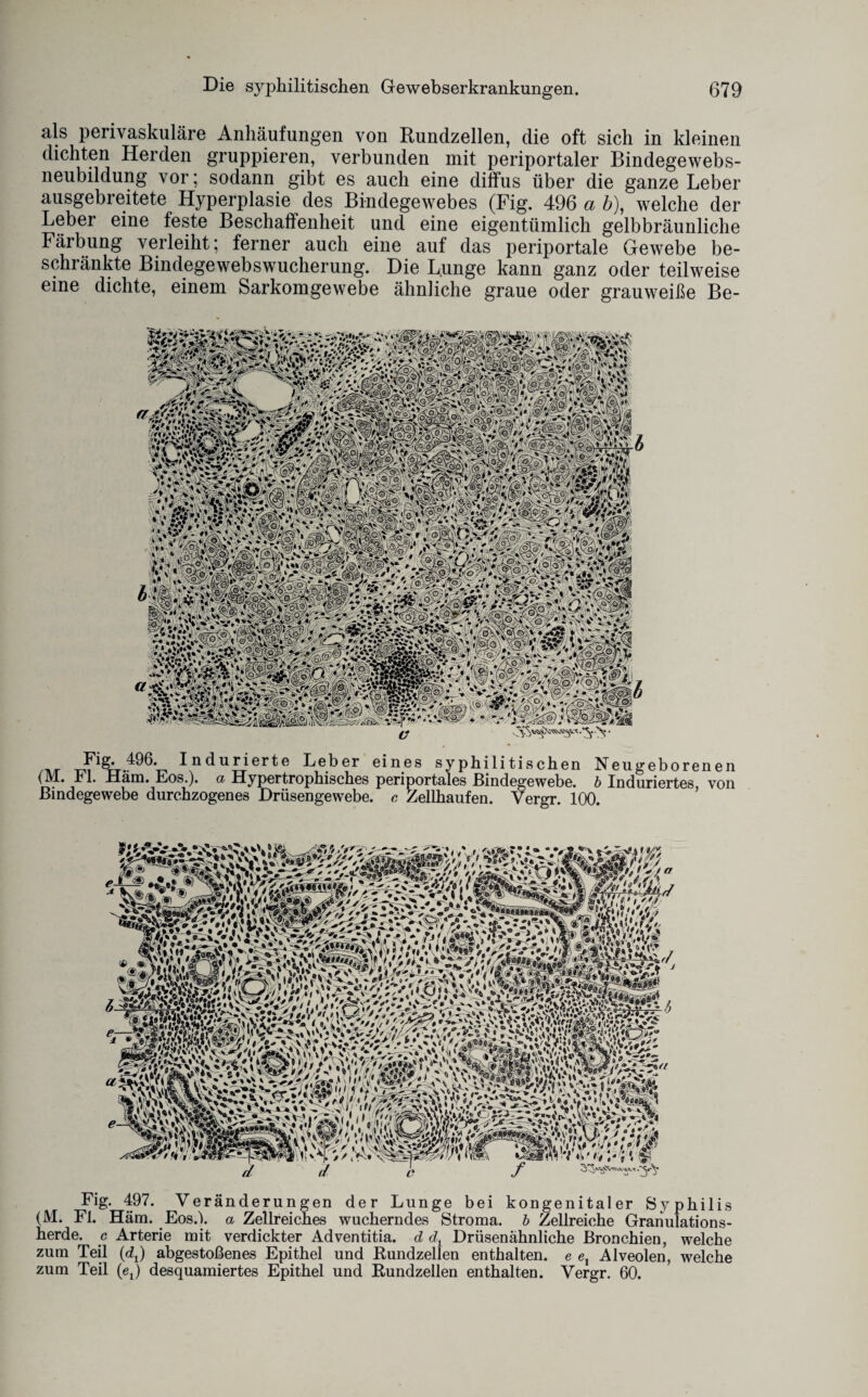 als perivaskuläre Anhäufungen von Rundzellen, die oft sich in kleinen dichten Herden gruppieren, verbunden mit periportaler Bindegewebs¬ neubildung vor; sodann gibt es auch eine diffus über die ganze Leber ausgebreitete Hyperplasie des Bindegewebes (Fig. 496 a b), welche der Leber eine feste Beschaffenheit und eine eigentümlich gelbbräunliche Färbung verleiht; ferner auch eine auf das periportale Gewebe be¬ schränkte Bindegewebswucherung. Die Lunge kann ganz oder teilweise eine dichte, einem Sarkomgewebe ähnliche graue oder grauweiße Be- Fig. 496. Indurierte Leber eines syphilitischen Neugeborenen (M. r 1. Häm. Eos.), a Hypertrophisches periportales Bindegewebe, b Induriertes, von Bindegewebe durchzogenes Drüsengewebe, c Zellhaufen. Vergr. 100. Fig. 497. Veränderungen der Lunge bei kongenitaler Syphilis (M. FI. Häm. Eos.). a Zellreiches wucherndes Stroma, b Zellreiche Granulations¬ herde. c Arterie mit verdickter Adventitia. d dx Drüsenähnliche Bronchien, welche zum Teil (dt) abgestoßenes Epithel und Kundzellen enthalten, e ex Alveolen, welche zum Teil (ej desquamiertes Epithel und Rundzellen enthalten. Vergr. 60.
