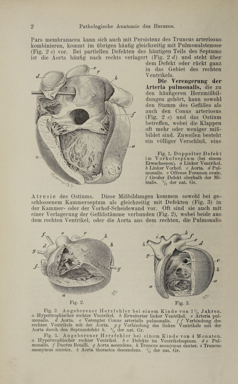 Pars membranacea kann sich auch mit Persistenz des Truncus arteriosus kombinieren, kommt im übrigen häufig gleichzeitig mit Pulmonalstenose (Fig. 2 e) vor. Bei partiellen Defekten des häutigen Teils des Septums ist die Aorta häufig nach rechts verlagert (Fig. 2 d) und steht über dem Defekt oder rückt ganz in das Gebiet des rechten Ventrikels. Die Verengerung der Arteria pulmonalis, die zu den häutigeren Herzmißbil¬ dungen gehört, kann sowohl den Stamm des Gefäßes als auch den Conus arteriosus (Fig. 2 e) und das Ostium betreffen, wobei die Klappen oft mehr oder weniger miß- bildet sind. Zuweilen besteht ein völliger Verschluß, eine Fig. 1. Doppelter Defekt im Vorhofseptum (bei einem Erwachsenen), a Linker Ventrikel.. b Linker Vorhof. c Aorta, d Pul¬ monalis. e Offenes Foramen ovale. f Großer Defekt oberhalb der Mi¬ tralis. Vj der nat. Gr. Atresie des Ostiums. Diese Mißbildungen kommen sowohl bei ge¬ schlossenem Kammerseptum als gleichzeitig mit Defekten (Fig. 3) in der Kammer- oder der Vorliof-Scheidewand vor. Oft sind sie auch mit einer Verlagerung der Gefäßstämme verbunden (Fig. 2), wobei beide aus- dem rechten Ventrikel, oder die Aorta aus dem rechten, die Pulmonalis Fig. 2. Fig. 3. Fig. 2. Angeborener Herzfehler bei einem Kinde von l1/^ Jahren.. a Hypertrophischer rechter Ventrikel, b Erweiterter linker Ventrikel, c Arteria pul¬ monalis. d Aorta, e Verengter Conus arterialis pulmonalis. ff Verbindung des rechten Ventrikels mit der Aorta, gg Verbindung des linken Ventrikels mit der Aorta durch den Septumdefekt h. 1/2 der nat. Gr. Fig. 3. Angeborener Herzfehler bei einem. Kinde von 4 Monaten. a Hypertrophischer rechter Ventrikel, b c Defekte im Ventrikelseptum, d e Pul¬ monalis. f Ductus Botalli. g Aorta ascendens. h Truncus anonymus dexter, i Truncus- anonymus sinister, k Aorta thoracica descendens. der nat. Gr.