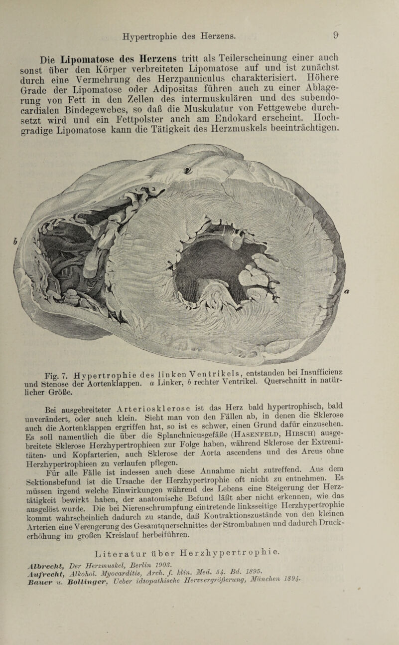 Die Lipomatose des Herzens tritt als Teilerscheinung einer auch sonst über den Körper verbreiteten Lipomatose auf und ist zunächst durch eine Vermehrung des Herzpanniculus charakterisiert. Höhere Grade der Lipomatose oder Adipositas führen auch zu einer Ablage¬ rung von Fett in den Zellen des intermuskulären und des subendo- cardialen Bindegewebes, so daß die Muskulatur von Fettgewebe durch¬ setzt wird und ein Fettpolster auch am Endokard erscheint. Hoch¬ gradige Lipomatose kann die Tätigkeit des Herzmuskels beeinträchtigen. Fie 7 Hypertrophie des linken Ventrikels, entstanden bei Insufficienz und Stenose der Aortenklappen, a Linker, b rechter Ventrikel. Querschnitt in natür¬ licher Größe. Bei ausgebreiteter Arteriosklerose ist das Herz bald hypertrophisch, bald unverändert, oder auch klein. Sieht man von den Fällen ab, in denen die Sklerose auch die Aortenklappen ergriffen hat, so ist es schwer, einen Grund dafür einzuse en. Es soll namentlich die über die Splanchnicusgefäße (Hasenfeld, Hirsch) ausge¬ breitete Sklerose Herzhypertrophieen zur Folge haben, während Sklerose der Extremi¬ täten- und Kopfarterien, auch Sklerose der Aorta ascendens und des Arcus ohne Herzhypertrophieen zu verlaufen pflegen. . Für alle Fälle ist indessen auch diese Annahme nicht zutreffend. Aus dem Sektionsbefund ist die Ursache der Herzhypertrophie oft nicht zu entnehmen. Es müssen irgend welche Einwirkungen während des Lebens eine Steigerung der Herz¬ tätigkeit bewirkt haben, der anatomische Befund läßt aber nicht erkennen, wie das ausgelöst wurde. Die bei Nierenschrumpfung eintretende linksseitige Herzhypertrophie kommt wahrscheinlich dadurch zu stände, daß Kontraktionszustände von den kleinen Arterien eine Verengerung des Gesamtquerschnittes der Strombahnen und dac nrc 1 rm erhöhung im großen Kreislauf herbeiführen. Literatur über Herzhypertrophie. Albrecht, Der Herzmuskel, Berlin 1903. Aufrecht, Alkohol. Mpocarditis, Arch. f. klin. Med. 54. Bd. 1895. Bauer u. Bollinger, lieber idiopathische Herzvergrößerung, München 189