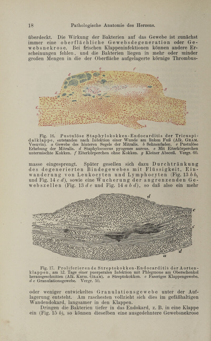 überdeckt. Die Wirkung der Bakterien auf das Gewebe ist zunächst immer eine oberflächliche Gewebsdegeneration oder Ge- websnekrose. Bei frischen Klappeninfektionen können andere Er¬ scheinungen fehlen, und die Bakterien liegen in mehr oder minder großen Mengen in die der Oberfläche aufgelagerte körnige Thrombus- Fig. 16. Pustulöse Staphylokokken-Endocarditis der Tricuspi- dalklappe, entstanden nach Infektion einer Wunde am linken Fuß (Alk. Gram. Vesuvin), a Gewebe des hinteren Segels der Mitralis, b Sehnenfaden, c Pustulöse Erhebung der Mitralis, d Staphylococcus pyogenes aureus, e Mit Eiterkörperchen untermischte Kokken, f Eiterkörperchen ohne Kokken, g Kleiner Absceß. Vergr. 60. masse eingesprengt. Später gesellen sich dazu Durchtränkung des degenerierten Bindegewebes mit Flüssigkeit, Ein¬ wanderung von Leukocyten und Lymphocyten (Fig. 13 b und Fig. 14 c d), sowie eine Wucherung der angrenzenden Ge¬ webszellen (Fig. 13 clc und Fig. 14 abd), so daß also ein mehr Fig. 17. Proliferier en de Streptokokken-Endocarditis der Aorten¬ klappen, am 12. Tage einer puerperalen Infektion mit Phlegmone am Oberschenkel herausgeschnitten (Alk. Karm. Gram), a Streptokokken, c Faseriges Klappengewebe. d e Granulationsgewebe. Vergr. 50. oder weniger entwickeltes Granulationsgewebe unter der Auf¬ lagerung entsteht. Am raschesten vollzieht sich dies im gefäßhaltigen Wandendokard, langsamer in den Klappen. Dringen die Bakterien tiefer in das Endokard, z. B. in eine Klappe ein (Fig. 15 b), so können dieselben eine ausgedehntere Gewebsnekrose