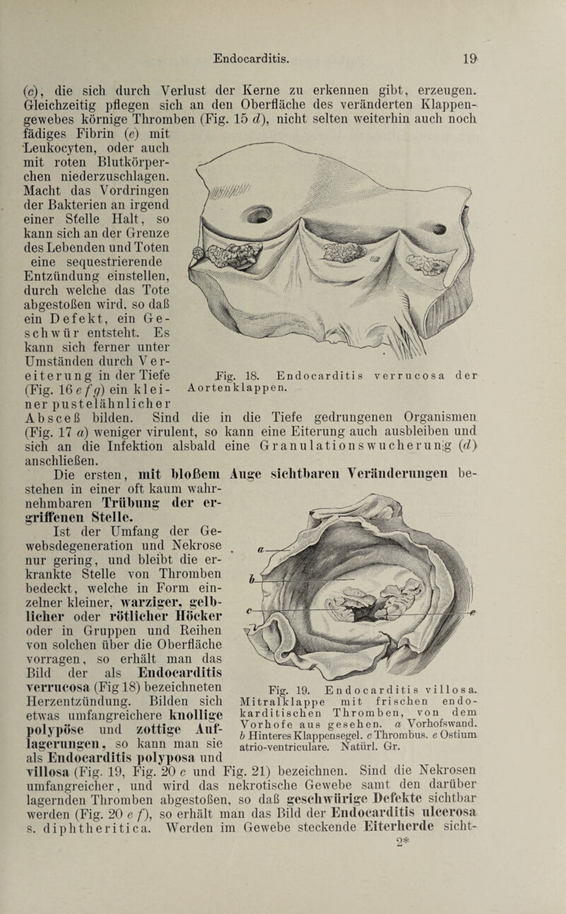 Fig. 18. Endocarditis Aortenklappen. (e), die sich durch Verlust der Kerne zu erkennen gibt, erzeugen. Gleichzeitig pflegen sich an den Oberfläche des veränderten Klappen¬ gewebes körnige Thromben (Fig. 15 d), nicht selten weiterhin auch noch fädiges Fibrin (e) mit Leukocyten, oder auch mit roten Blutkörper¬ chen niecl erzuschlagen. Macht das Vordringen der Bakterien an irgend einer Stelle Halt, so kann sich an der Grenze des Lebenden und Toten eine sequestrierende Entzündung einstelien, durch welche das Tote abgestoßen wird, so daß ein Defekt, ein Ge¬ schwür entsteht. Es kann sich ferner unter Umständen durch Ver¬ eiterung in der Tiefe (Fig. Ißefg) ein klei¬ ner p u st e 1 ähnlich er Absceß bilden. Sind die in die Tiefe gedrungenen Organismen (Fig. 17 a) weniger virulent, so kann eine Eiterung auch ausbleiben und sich an die Infektion alsbald eine Granulationswucherunig (d) anschließen. Die ersten, mit bloßem Auge sichtbaren Veränderungen be¬ stehen in einer oft kaum wahr¬ nehmbaren Trübung der er¬ griffenen Stelle. Ist der Umfang der Ge- websdegeneration und Nekrose nur gering, und bleibt die er¬ krankte Stelle von Thromben bedeckt, welche in Form ein¬ zelner kleiner, warziger, gelb¬ licher oder rötlicher Höcker oder in Gruppen und Reihen von solchen über die Oberfläche vorragen, so erhält man das Bild der als Endocarditis verrucosa (Fig 18) bezeichneten Fig. 19. Endocarditis villosa. Herzentzündung. Bilden sich Mitralklappe mit frischen endo- etwas umfangreichere knollige karditischen Thromben, von dem imlvniUp und zottige Auf- Vorhofe aus gesehen, a Vorhofswand. pOlypOSe und zotll^e l ö Hinteres Klappensegel, c Thrombus. eOstium lagerungen, so kann man sie atrio-ventriculare. Natürl. Gr. als Endocarditis polyposa und villosa (Fig. 19, Fig. 20 c und Fig. 21) bezeichnen. Sind die Nekrosen umfangreicher, und wird das nekrotische Gewebe samt den darüber lagernden Thromben abgestoßen, so daß geschwiirige Defekte sichtbar werden (Fig. 20 e f), so erhält man das Bild der Endocarditis ulcerosa s. diphtheritica. Werden im Gewebe steckende Eiterherde sicht- 2*