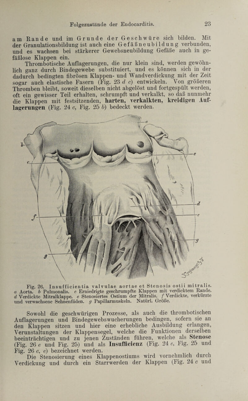 am Rande und im Grunde der Geschwüre sich bilden. Mit der Granulationsbildung ist auch eine Gefäßneubildung verbunden, und es wachsen bei stärkerer Gewebsneubildung Gefäße auch in ge¬ fäßlose Klappen ein. Thrombotische Auflagerungen, die nur klein sind, werden gewöhn¬ lich ganz durch Bindegewebe substituiert, und es können sich in der dadurch bedingten fibrösen Klappen- und Wandverdickung mit der Zeit sogar auch elastische Fasern (Fig. 23 d c) entwickeln. Von größeren Thromben bleibt, soweit dieselben nicht abgelöst und fortgespült werden, oft ein gewisser Teil erhalten, schrumpft und verkalkt, so daß nunmehr die Klappen mit festsitzenden, harten, verkalkten, kreidigen Auf¬ lagerungen (Fig. 24 c, Fig. 25 b) bedeckt werden. Sowohl die geschwürigen Prozesse, als auch die thrombotischen Auflagerungen und Bindegewebswucherungen bedingen, sofern sie an den Klappen sitzen und hier eine erhebliche Ausbildung erlangen, Verunstaltungen der Klappensegel, welche die Funktionen derselben beeinträchtigen und zu jenen Zuständen führen, welche als Stenose (Fig. 26 e und Fig. 25) und als Insufficienz (Fig. 24 e, Fig. 25 und Fig. 26 c, e) bezeichnet werden. Die Stenosierung eines Klappenostiums wird vornehmlich durch Verdickung und durch ein Starrwerden der Klappen (!ig. 24 c und Fig. 26. Insufficientia valvulae aortae et Stenosis ostii mitralis. a Aorta, b Pulmonalis. c Erniedrigte geschrumpfte Klappen mit verdicktem Rande. d Verdickte Mitralklappe, e Stenosiertes Ostium der Mitralis. /Verdickte, verkürzte und verwachsene Sehnenfäden, g Papillarmuskeln. Natürl. Größe.