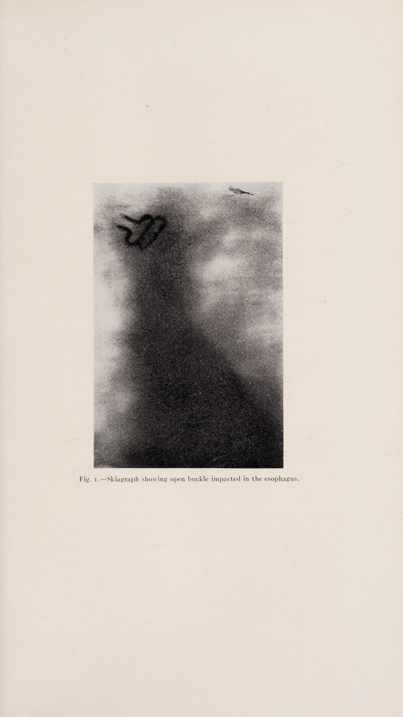 Fig. i.—Skiagraph showing open buckle impacted in the esophagus.