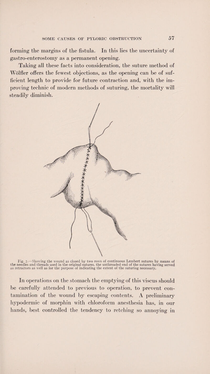 forming the margins of the fistula. In this lies the uncertainty of gastro-enterostomy as a permanent opening. Taking all these facts into consideration, the suture method of Wolfler offers the fewest objections, as the opening can be of suf¬ ficient length to provide for future contraction and, with the im¬ proving technic of modern methods of suturing, the mortality will steadily diminish. Fig. 7.—Showing the wound as closed by two rows of continuous Lembert sutures by means of the needles and threads used in the original sutures, the unthreaded end of the sutures having served as retractors as well as for the purpose of indicating the extent of the suturing necessary. In operations on the stomach the emptying of this viscus should be carefully attended to previous to operation, to prevent con¬ tamination of the wound by escaping contents. A preliminary hypodermic of morphin with chloroform anesthesia has, in our hands, best controlled the tendency to retching so annoying in