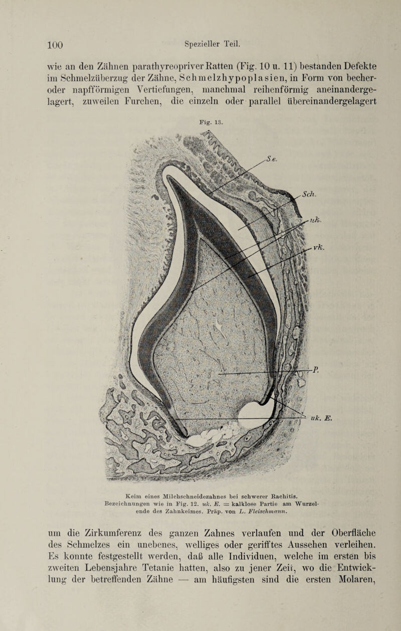 wie an den Zähnen parathyreopriver Eatten (Fig. 10 u. 11) bestanden Defekte im Schmelzüberzng der Zähne, Schmelzhypoplasien, in Form von becher- oder napfförmigen Vertiefungen, manchmal reihenförmig aneinanderge¬ lagert, zuweilen Furchen, die einzeln oder parallel übereinandergelagert Fig. 13. Keim eines Milchschneidezahnes bei schwerer Bachitis. Bezeichnungen wie in Fig. 12. wk. E. — kalklose Partie am Wurzel¬ ende des Zahnkeimes. Präp. von L. Fleischmann. um die Zirkumferenz des ganzen Zahnes verlaufen und der Oberfläche des Schmelzes ein unebenes, welliges oder gerilltes Aussehen verleihen. Es konnte festgestellt werden, daß alle Individuen, welche im ersten bis zweiten Lebensjahre Tetanie hatten, also zu jener Zeit, wo die Entwick¬ lung der betreffenden Zähne — am häufigsten sind die ersten Molaren,