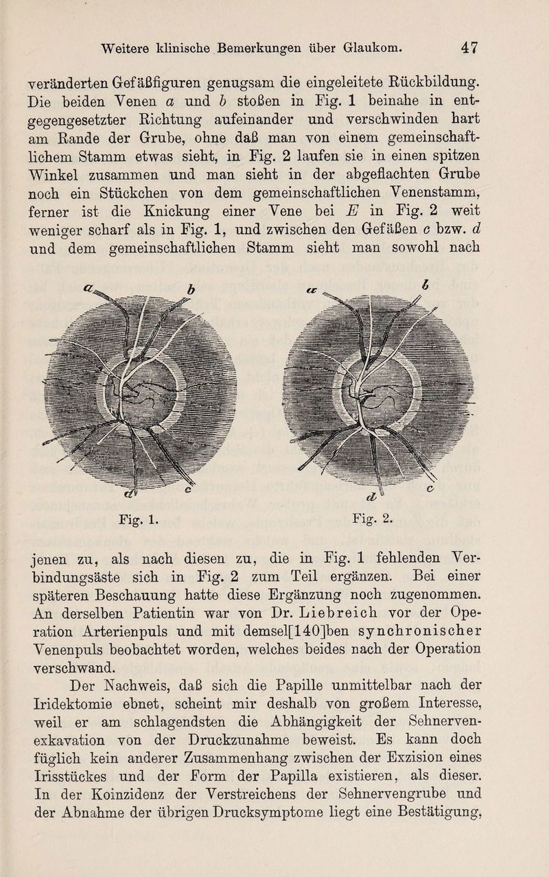 veränderten Gef äßfiguren genugsam die eingeleitete Rückbildung. Die beiden Venen a und b stoßen in Fig. 1 beinahe in ent¬ gegengesetzter Richtung aufeinander und verschwinden hart am Rande der Grube, ohne daß man von einem gemeinschaft¬ lichem Stamm etwas sieht, in Fig. 2 laufen sie in einen spitzen Winkel zusammen und man sieht in der abgeflachten Grube noch ein Stückchen von dem gemeinschaftlichen Venenstamm, ferner ist die Knickung einer Vene bei E in Fig. 2 weit weniger scharf als in Fig. 1, und zwischen den Gefäßen c bzw. d und dem gemeinschaftlichen Stamm sieht man sowohl nach Fig. 1. Fig. 2. jenen zu, als nach diesen zu, die in Fig. 1 fehlenden Ver¬ bindungsäste sich in Fig. 2 zum Teil ergänzen. Bei einer späteren Beschauung hatte diese Ergänzung noch zugenommen. An derselben Patientin war von Dr. Liebreich vor der Ope¬ ration Arterienpuls und mit demsel[140]ben synchronischer Venenpuls beobachtet worden, welches beides nach der Operation verschwand. Der Nachweis, daß sich die Papille unmittelbar nach der Iridektomie ebnet, scheint mir deshalb von großem Interesse, weil er am schlagendsten die Abhängigkeit der Sehnerven¬ exkavation von der Druckzunahme beweist. Es kann doch füglich kein anderer Zusammenhang zwischen der Exzision eines Irisstückes und der Form der Papilla existieren, als dieser. In der Koinzidenz der Verstreichens der Sehnervengrube und der Abnahme der übrigen Drucksymptome liegt eine Bestätigung,