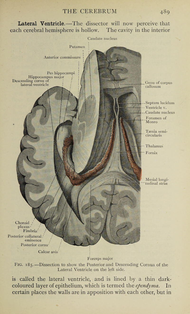 Lateral Ventricle.—The dissector will now perceive that each cerebral hemisphere is hollow. The cavity in the interior Caudate nucleus Choroid / plexus' Fimbria' Posterior collateral/ eminence Posterior cornu' Putamen ; Anterior commissure Pes hippocampi Hippocampus major j Descending cornu of lateral ventricle Genu of corpus callosum Mesial longi- 'tudinal stria; Septum lucidum Ventricle v. Caudate nucleus Foramen of Monro Taenia semi- circularis Thalamus Fornix Calcar avis Forceps major Fig. 185.—Dissection to show the Posterior and Descending Cornua of the Lateral Ventricle on the left side. is called the lateral ventricle, and is lined by a thin dark- coloured layer of epithelium, which is termed the ependyma. In certain places the walls are in apposition with each other, but in