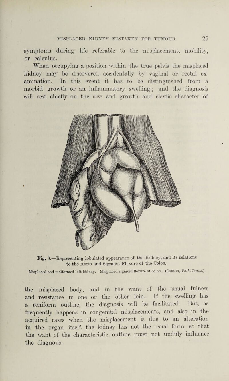 MISPLACED KIDNEY MISTAKEN FOR TUMOUR. 95 symptoms during life referable to the misplacement, mobility, or calculus. When occupying a position within the true pelvis the misplaced kidney may be discovered accidentally by vaginal or rectal ex¬ amination. In this event it has to be distinguished from a morbid growth or an inflammatory swelling; and the diagnosis will rest chiefly on the size and growth and elastic character of Fig. 8.—Representing lobulated appearance of the Kidney, and its relations to the Aorta and Sigmoid Flexure of the Colon. Misplaced and malformed left kidney. Misplaced sigmoid flexure of colon. (Canton, Path. Irans.) the misplaced body, and in the want of the usual fulness and resistance in one or the other loin. If the swelling has a reniform outline, the diagnosis will be facilitated. But, as frequently happens in congenital misplacements, and also in the acquired cases when the misplacement is due to an alteration in the organ itself, the kidney has not the usual form, so that the want of the characteristic outline must not unduly influence the diagnosis.
