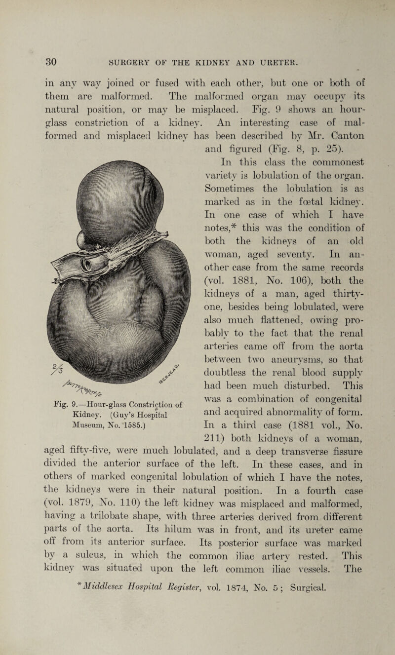 in any way joined or fused with each other, but one or both of them are malformed. The malformed organ may occupy its natural position, or may be misplaced. Fig. 9 shows an hour¬ glass constriction of a kidney. An interesting case of mal¬ formed and misplaced kidney has been described by Mr. Canton and figured (Fig. 8, p. 25). In this class the commonest variety is lobulation of the organ. Sometimes the lobulation is as marked as in the foetal kidney. «/ In one case of which I have notes,* this was the condition of both the kidneys of an old woman, aged seventy. In an¬ other case from the same records (vol. 1881, No. 106), both the kidneys of a man, aged thirty- one, besides being lobulated, were also much flattened, owing pro¬ bably to the fact that the renal arteries came off from the aorta between two aneurysms, so that doubtless the renal blood supply had been much disturbed. This was a combination of congenital and acquired abnormality of form. In a third case (1881 vol., No. 211) both kidneys of a woman, aged fifty-five, were much lobulated, and a deep transverse fissure divided the anterior surface of the left. In these cases, and in others of marked congenital lobulation of which I have the notes, the kidneys were in their natural position. In a fourth case (vol. 1879, No. 110) the left kidnev was misplaced and malformed, having a trilobate shape, with three arteries derived from different parts of the aorta. Its hilum was in front, and its ureter came off from its anterior surface. Its posterior surface was marked by a sulcus, in which the common iliac artery rested. This kidney was situated upon the left common iliac vessels. The * Middlesex Hospital Register, vol. 1874, No. 5 ; Surgical. Fig. 9.—Hour-glass Constriction of Kidney. (Guy’s Hospital Museum, No. 1585.)