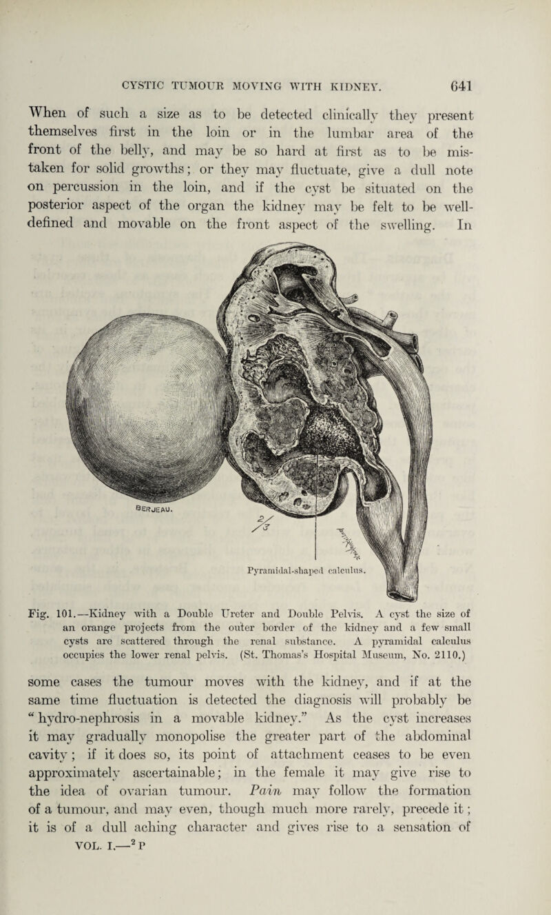 When of such a size as to be detected clinically they present themselves first in the loin or in the lumbar area of the front of the belly, and may be so hard at first as to be mis¬ taken for solid growths; or they may fluctuate, give a dull note on percussion in the loin, and if the cyst be situated on the posterior aspect of the organ the kidney may lie felt to be well- defined and movable on the front aspect of the swelling. In Fig. 101.—Kidney with, a Double Ureter and Double Pelvis. A cyst the size of an orange projects from the outer border of the kidney and a few small cysts are scattered through the renal substance. A pyramidal calculus occupies the lower renal pelvis. (St. Thomas’s Hospital Museum, No. 2110.) some cases the tumour moves with the kidney, and if at the same time fluctuation is detected the diagnosis will probably be “ hydro-nephrosis in a movable kidney.” As the cyst increases it may gradually monopolise the greater part of the abdominal cavity ; if it does so, its point of attachment ceases to be even approximately ascertainable; in the female it may give rise to the idea of ovarian tumour. Pain may follow the formation of a tumour, and may even, though much more rarely, precede it; it is of a dull aching character and gives rise to a sensation of VOL. I.—2P