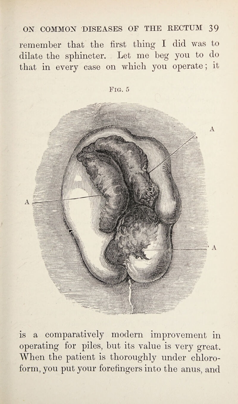 remember that the first thing I did was to dilate the sphincter. Let me beg yon to do that in every case on which yon operate; it Fig. 5 is a comparatively modern improvement in operating for piles, but its value is very great. When the patient is thoroughly under chloro¬ form, you put your forefingers into the anus, and
