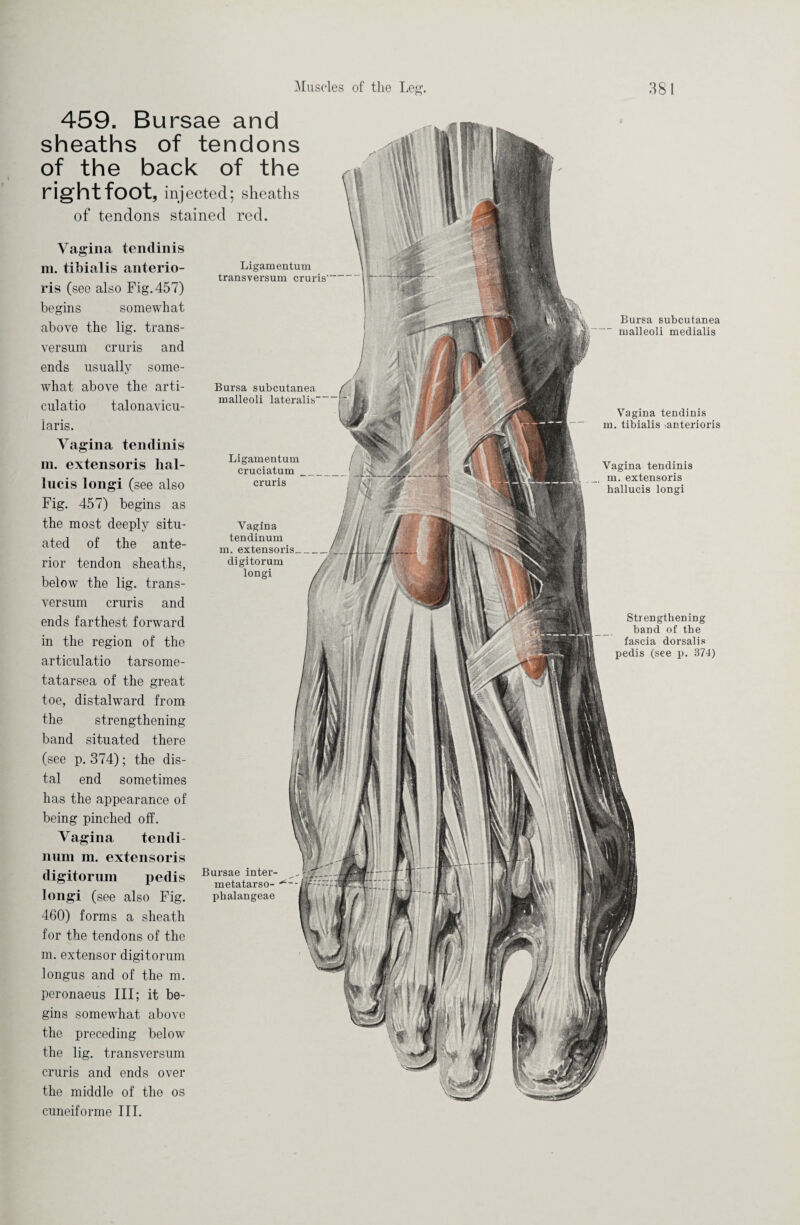 Strengthening band of the fascia dorsalis pedis (see p. 374) Bursa subcutanea malleoli medialis Vagina tendinis m. tibialis ianterioris Vagina tendinis m. extensoris hallucis longi 459. Bursae and sheaths of tendons of the back of the right foot, injected; sheaths of tendons stained red. Vagina tendinis m. tibialis anterio- ris (see also Fig. 457) begins somewhat above the lig. trans- versum cruris and ends usually some¬ what above the arti- culatio talonavicu- iaris. Vagina tendinis m. extensoris lial- lucis longi (see also Fig. 457) begins as the most deeply situ¬ ated of the ante¬ rior tendon sheaths, below the lig. trans- versum cruris and ends farthest forward in the region of the articulatio tarsome- tatarsea of the great toe, distalward from the strengthening band situated there (see p. 374); the dis¬ tal end sometimes has the appearance of being pinched off. Vagina tendi- nura m. extensoris digitorum pedis longi (see also Fig. 460) forms a sheath for the tendons of the m. extensor digitorum longus and of the m. peronaeus III; it be¬ gins somewhat above the preceding below the lig. transversum cruris and ends over the middle of the os cuneiforme III. Ligamentum transversum cruris-“ Bursa subcutanea malleoli lateralis Bursae inter- metatarso- ^ pbalangeae Ligamentum cruciatum cruris Vagina tendinum m. extensoris_ digitorum longi