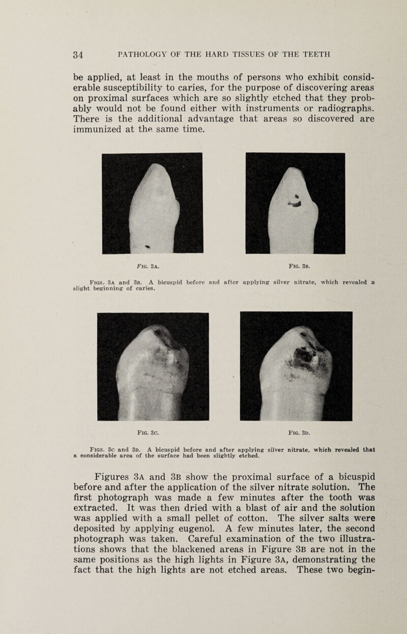 be applied, at least in the mouths of persons who exhibit consid¬ erable susceptibility to caries, for the purpose of discovering areas on proximal surfaces which are so slightly etched that they prob¬ ably would not be found either with instruments or radiographs. There is the additional advantage that areas so discovered are immunized at the same time. Fig. 3a. Fig. 3b. Figs. 3a and 3b. A bicuspid before and after applying silver nitrate, which revealed a slight beginning of caries. Fig. 3c. Fig. 3d. Figs. 3c and 3d. A bicuspid before and after applying silver nitrate, which revealed that a considerable area of the surface had been slightly etched. Figures 3a and 3b show the proximal surface of a bicuspid before and after the application of the silver nitrate solution. The first photograph was made a few minutes after the tooth was extracted. It was then dried with a blast of air and the solution was applied with a small pellet of cotton. The silver salts were deposited by applying eugenol. A few minutes later, the second photograph was taken. Careful examination of the two illustra¬ tions shows that the blackened areas in Figure 3b are not in the same positions as the high lights in Figure 3a, demonstrating the fact that the high lights are not etched areas. These two begin-