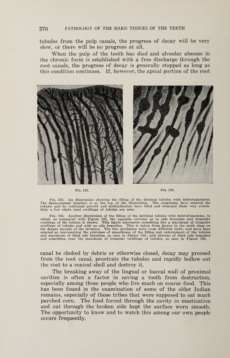 tubules from the pulp canals, the progress of decay will be very slow, or there will be no progress at all. When the pulp of the tooth has died and alveolar abscess in the chronic form is established with a free discharge through the root canals, the progress of decay is generally stopped as long as this condition continues. If, however, the apical portion of the root Fig. 192. Fig. 193. Fig. 192. An illustration showing the filling of the dentinal tubules with microorganisms. The dento-enamel junction is at the top of the illustration. The organisms have entered the tubules and by continued growth and multiplication have filled and enlarged them very evenly. Only a few slight local swellings of tubules are seen. Fig. 193. Another illustration of the filling of the dentinal tubules with microorganisms, in which, as compared with Figure 192, the opposite extreme as to side branches and irregular swellings of the tubules is shown. This figure represents something like a maximum of irregular swefiings of tubules and with no side branches. This is taken from deeper in the tooth close on the deeper margin of the invasion. The two specimens were from different teeth, and have been selected as representing the extremes of smoothness of the filling and enlargement of the tubules and maximum of filled side branches, as seen in Figure 192 ; and absence of filled side branches and something near the maximum of irregular swellings of tubules, as seen in Figure 193. canal be choked by debris or otherwise closed, decay may proceed from the root canal, penetrate the tubules and rapidly hollow out the root to a conical shell and destroy it. The breaking away of the lingual or buccal wall of proximal cavities is often a factor in saving a tooth from destruction, especially among those people who live much on coarse food. This has been found in the examination of some of the older Indian remains, especially of those tribes that were supposed to eat much parched corn. The food forced through the cavity in mastication and out through the broken side kept the surface worn smooth. The opportunity to know and to watch this among our own people occurs frequently.