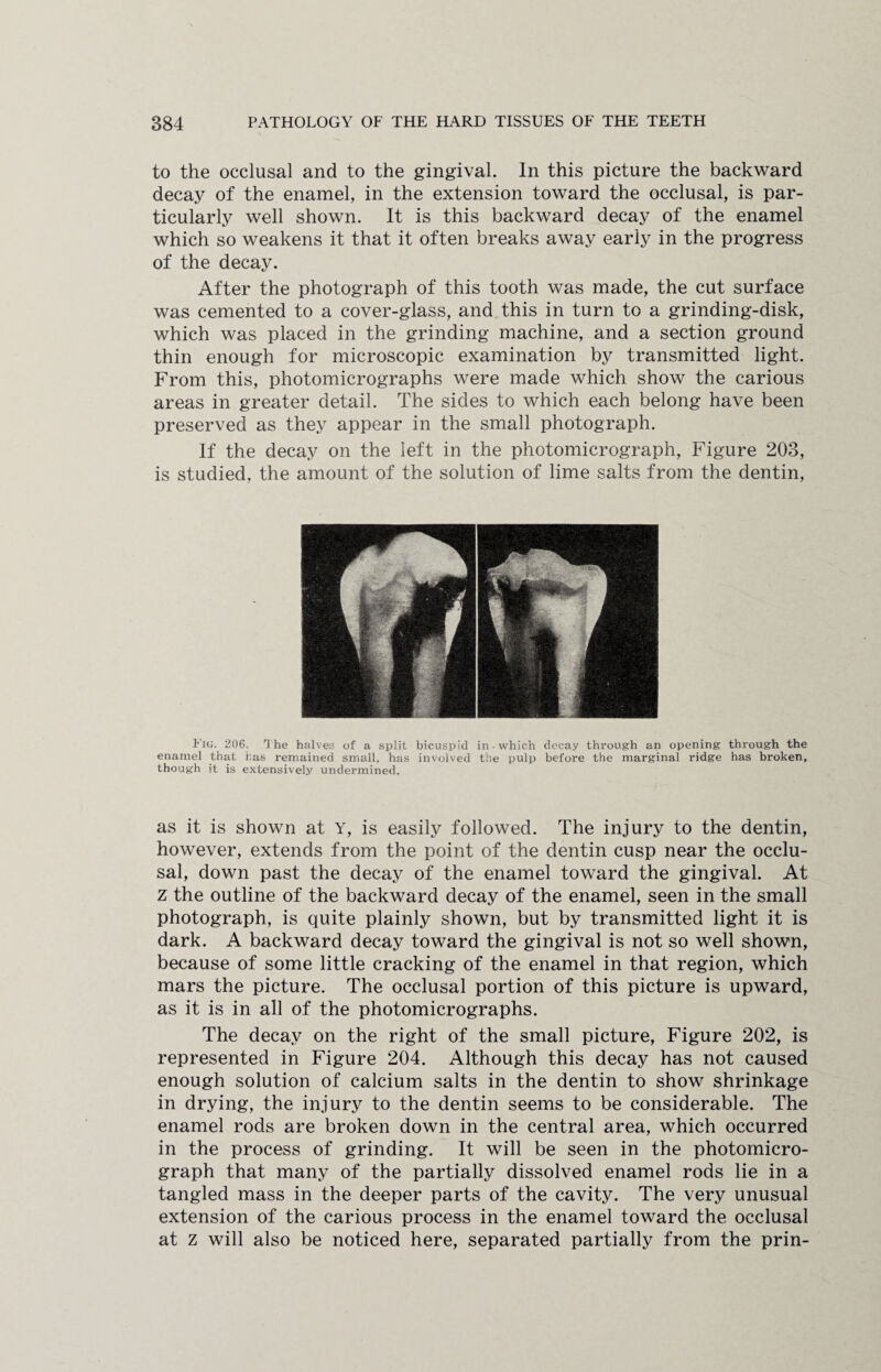 to the occlusal and to the gingival. In this picture the backward decay of the enamel, in the extension toward the occlusal, is par¬ ticularly well shown. It is this backward decay of the enamel which so weakens it that it often breaks away early in the progress of the decay. After the photograph of this tooth was made, the cut surface was cemented to a cover-glass, and this in turn to a grinding-disk, which was placed in the grinding machine, and a section ground thin enough for microscopic examination by transmitted light. From this, photomicrographs were made which show the carious areas in greater detail. The sides to which each belong have been preserved as they appear in the small photograph. If the decay on the left in the photomicrograph, Figure 203, is studied, the amount of the solution of lime salts from the dentin, Jig. 206. The halves of a split bicuspid in which decay through an opening through the enamel that has remained small, has involved the pulp before the marginal ridge has broken, though it is extensively undermined. as it is shown at Y, is easily followed. The injury to the dentin, however, extends from the point of the dentin cusp near the occlu¬ sal, down past the decay of the enamel toward the gingival. At z the outline of the backward decay of the enamel, seen in the small photograph, is quite plainly shown, but by transmitted light it is dark. A backward decay toward the gingival is not so well shown, because of some little cracking of the enamel in that region, which mars the picture. The occlusal portion of this picture is upward, as it is in all of the photomicrographs. The decay on the right of the small picture, Figure 202, is represented in Figure 204. Although this decay has not caused enough solution of calcium salts in the dentin to show shrinkage in drying, the injury to the dentin seems to be considerable. The enamel rods are broken down in the central area, which occurred in the process of grinding. It will be seen in the photomicro¬ graph that many of the partially dissolved enamel rods lie in a tangled mass in the deeper parts of the cavity. The very unusual extension of the carious process in the enamel toward the occlusal at z will also be noticed here, separated partially from the prin-