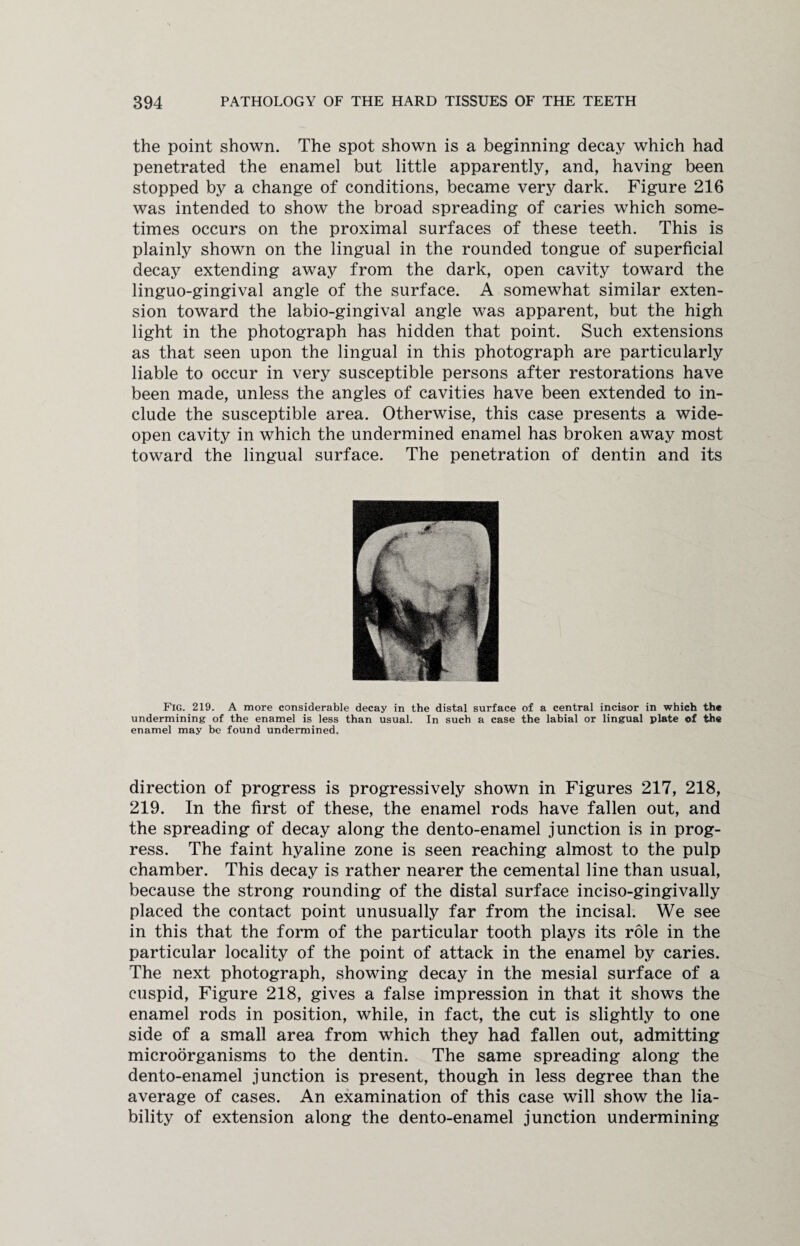 the point shown. The spot shown is a beginning decay which had penetrated the enamel but little apparently, and, having been stopped by a change of conditions, became very dark. Figure 216 was intended to show the broad spreading of caries which some¬ times occurs on the proximal surfaces of these teeth. This is plainly shown on the lingual in the rounded tongue of superficial decay extending away from the dark, open cavity toward the linguo-gingival angle of the surface. A somewhat similar exten¬ sion toward the labio-gingival angle was apparent, but the high light in the photograph has hidden that point. Such extensions as that seen upon the lingual in this photograph are particularly liable to occur in very susceptible persons after restorations have been made, unless the angles of cavities have been extended to in¬ clude the susceptible area. Otherwise, this case presents a wide- open cavity in which the undermined enamel has broken away most toward the lingual surface. The penetration of dentin and its Fig. 219. A more considerable decay in the distal surface of a central incisor in which the undermining of the enamel is less than usual. In such a case the labial or lingual plate of the enamel may be found undermined. direction of progress is progressively shown in Figures 217, 218, 219. In the first of these, the enamel rods have fallen out, and the spreading of decay along the dento-enamel junction is in prog¬ ress. The faint hyaline zone is seen reaching almost to the pulp chamber. This decay is rather nearer the cemental line than usual, because the strong rounding of the distal surface inciso-gingivally placed the contact point unusually far from the incisal. We see in this that the form of the particular tooth plays its role in the particular locality of the point of attack in the enamel by caries. The next photograph, showing decay in the mesial surface of a cuspid, Figure 218, gives a false impression in that it shows the enamel rods in position, while, in fact, the cut is slightly to one side of a small area from which they had fallen out, admitting microorganisms to the dentin. The same spreading along the dento-enamel junction is present, though in less degree than the average of cases. An examination of this case will show the lia¬ bility of extension along the dento-enamel junction undermining