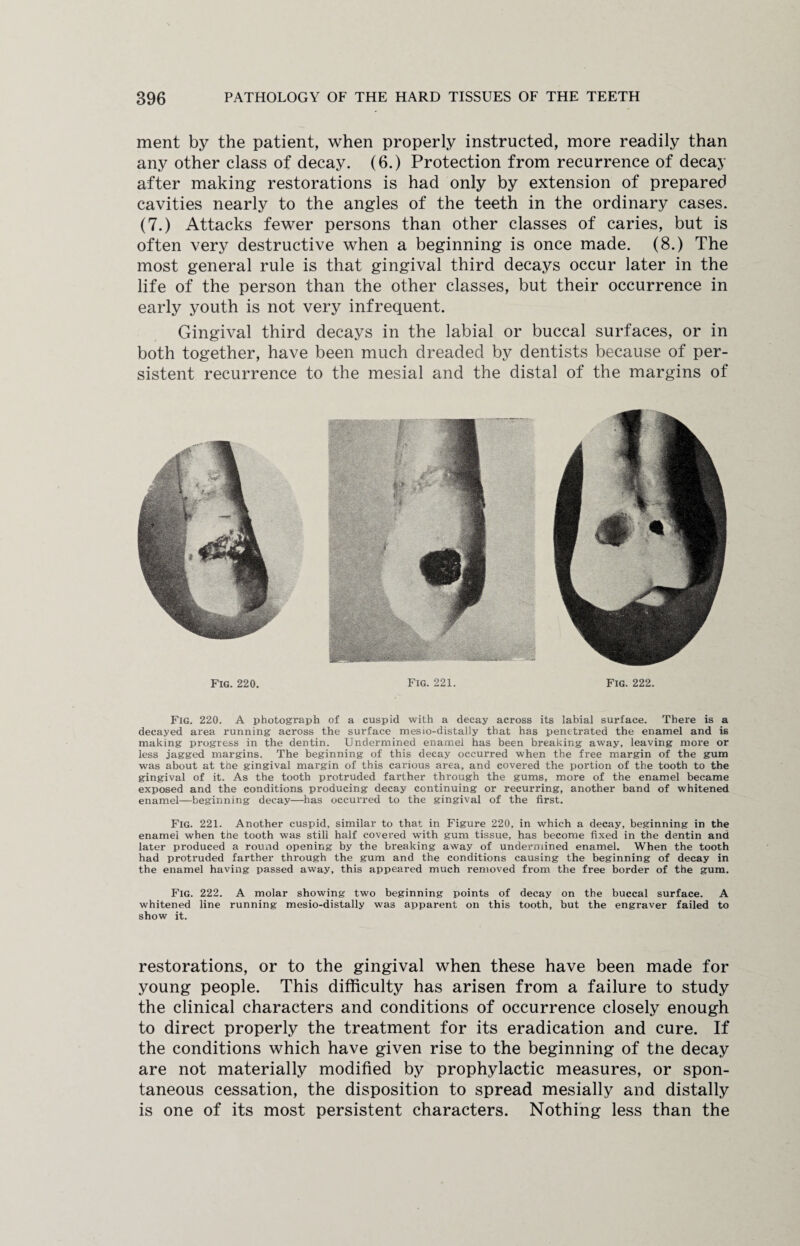 ment by the patient, when properly instructed, more readily than any other class of decay. (6.) Protection from recurrence of decay after making restorations is had only by extension of prepared cavities nearly to the angles of the teeth in the ordinary cases. (7.) Attacks fewer persons than other classes of caries, but is often very destructive when a beginning is once made. (8.) The most general rule is that gingival third decays occur later in the life of the person than the other classes, but their occurrence in early youth is not very infrequent. Gingival third decays in the labial or buccal surfaces, or in both together, have been much dreaded by dentists because of per¬ sistent recurrence to the mesial and the distal of the margins of Fig. 221 Fig. 222 Fig. 220 Fig. 220. A photograph of a cuspid with a decay across its labial surface. There is a decayed area running across the surface mesio-distally that has penetrated the enamel and is making progress in the dentin. Undermined enamel has been breaking away, leaving more or less jagged margins. The beginning of this decay occurred when the free margin of the gum was about at the gingival margin of this carious area, and covered the portion of the tooth to the gingival of it. As the tooth protruded farther through the gums, more of the enamel became exposed and the conditions producing decay continuing or recurring, another band of whitened enamel—beginning decay—has occurred to the gingival of the first. Fig. 221. Another cuspid, similar to that in Figure 220, in which a decay, beginning in the enamel when the tooth was still half covered with gum tissue, has become fixed in the dentin and later produced a round opening by the breaking away of undermined enamel. When the tooth had protruded farther through the gum and the conditions causing the beginning of decay in the enamel having passed away, this appeared much removed from the free border of the gum. Fig. 222. A molar showing two beginning points of decay on the buccal surface. A whitened line running mesio-distally was apparent on this tooth, but the engraver failed to show it. restorations, or to the gingival when these have been made for young people. This difficulty has arisen from a failure to study the clinical characters and conditions of occurrence closely enough to direct properly the treatment for its eradication and cure. If the conditions which have given rise to the beginning of the decay are not materially modified by prophylactic measures, or spon¬ taneous cessation, the disposition to spread mesially and distally is one of its most persistent characters. Nothing less than the