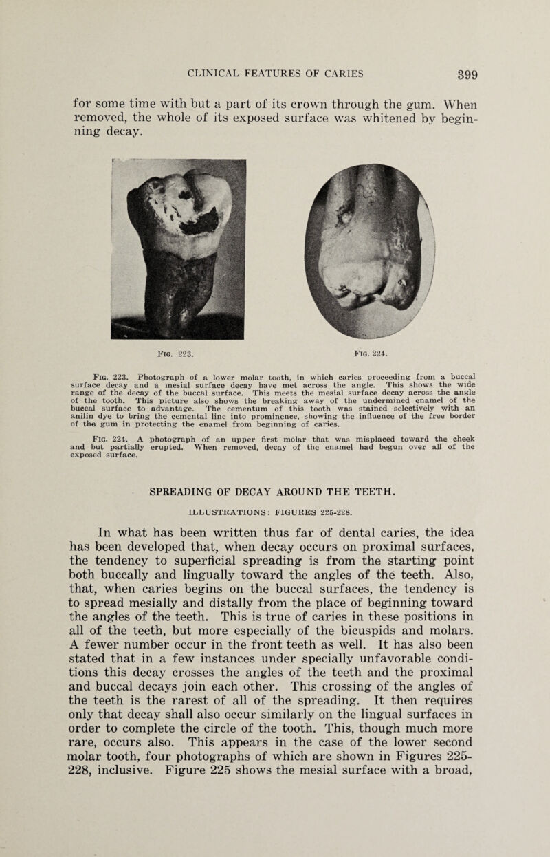 for some time with but a part of its crown through the gum. When removed, the whole of its exposed surface was whitened by begin¬ ning decay. Fig. 223. Fig. 224. Fig. 223. Photograph of a lower molar tooth, in which caries proceeding from a buccal surface decay and a mesial surface decay have met across the angle. This shows the wide range of the decay of the buccal surface. This meets the mesial surface decay across the angle of the tooth. This picture also shows the breaking away of the undermined enamel of the buccal surface to advantage. The cementum of this tooth was stained selectively with an anilin dye to bring the cemental line into prominence, showing the influence of the free border of the gum in protecting the enamel from beginning of caries. Fig. 224. A photograph of an upper first molar that was misplaced toward the cheek and but partially erupted. When removed, decay of the enamel had begun over all of the exposed surface. SPREADING OF DECAY AROUND THE TEETH. ILLUSTRATIONS: FIGURES 225-228. In what has been written thus far of dental caries, the idea has been developed that, when decay occurs on proximal surfaces, the tendency to superficial spreading is from the starting point both buccally and lingually toward the angles of the teeth. Also, that, when caries begins on the buccal surfaces, the tendency is to spread mesially and distally from the place of beginning toward the angles of the teeth. This is true of caries in these positions in all of the teeth, but more especially of the bicuspids and molars. A fewer number occur in the front teeth as well. It has also been stated that in a few instances under specially unfavorable condi¬ tions this decay crosses the angles of the teeth and the proximal and buccal decays join each other. This crossing of the angles of the teeth is the rarest of all of the spreading. It then requires only that decay shall also occur similarly on the lingual surfaces in order to complete the circle of the tooth. This, though much more rare, occurs also. This appears in the case of the lower second molar tooth, four photographs of which are shown in Figures 225- 228, inclusive. Figure 225 shows the mesial surface with a broad,