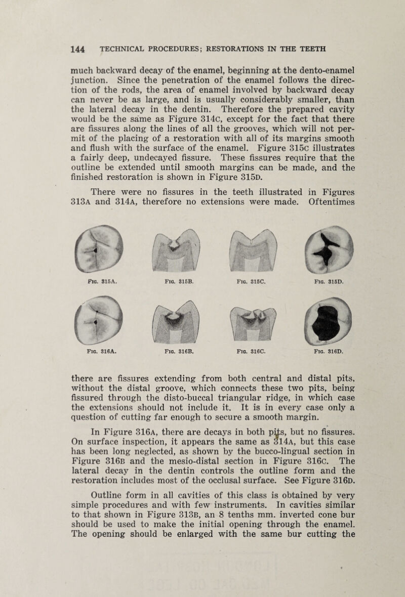 much backward decay of the enamel, beginning at the dento-enamel junction. Since the penetration of the enamel follows the direc¬ tion of the rods, the area of enamel involved by backward decay can never be as large, and is usually considerably smaller, than the lateral decay in the dentin. Therefore the prepared cavity would be the same as Figure 314c, except for the fact that there are fissures along the lines of all the grooves, which will not per¬ mit of the placing of a restoration with all of its margins smooth and flush with the surface of the enamel. Figure 315c illustrates a fairly deep, undecayed fissure. These fissures require that the outline be extended until smooth margins can be made, and the finished restoration is shown in Figure 315d. There were no fissures in the teeth illustrated in Figures 313a and 314a, therefore no extensions were made. Oftentimes Fig. 315A. Fig. 315B. Fig. 315C. Fig. 315D. Fig. 316A. Fig. 316B. Fig. 316C. Fig. 316D. there are fissures extending from both central and distal pits, without the distal groove, which connects these two pits, being fissured through the disto-buccal triangular ridge, in which case the extensions should not include it. It is in every case only a question of cutting far enough to secure a smooth margin. In Figure 316a, there are decays in both pits, but no fissures. On surface inspection, it appears the same as 314a, but this case has been long neglected, as shown by the bucco-lingual section in Figure 316b and the mesio-distal section in Figure 316c. The lateral decay in the dentin controls the outline form and the restoration includes most of the occlusal surface. See Figure 316d. Outline form in all cavities of this class is obtained by very simple procedures and with few instruments. In cavities similar to that shown in Figure 313b, an 8 tenths mm. inverted cone bur should be used to make the initial opening through the enamel. The opening should be enlarged with the same bur cutting the